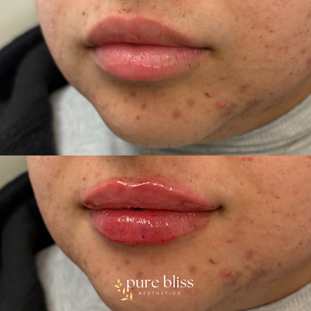 Half syringe of lip filler using 0.6ml Revanesse Versa.