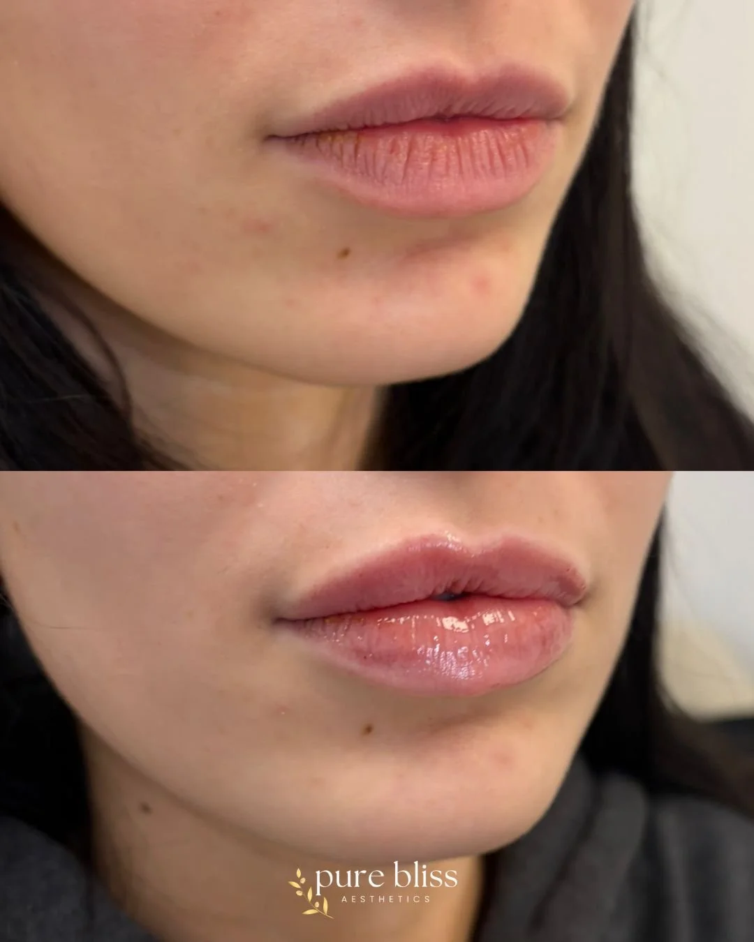Lip filler before and after using 0.6ml Revanesse Versa.