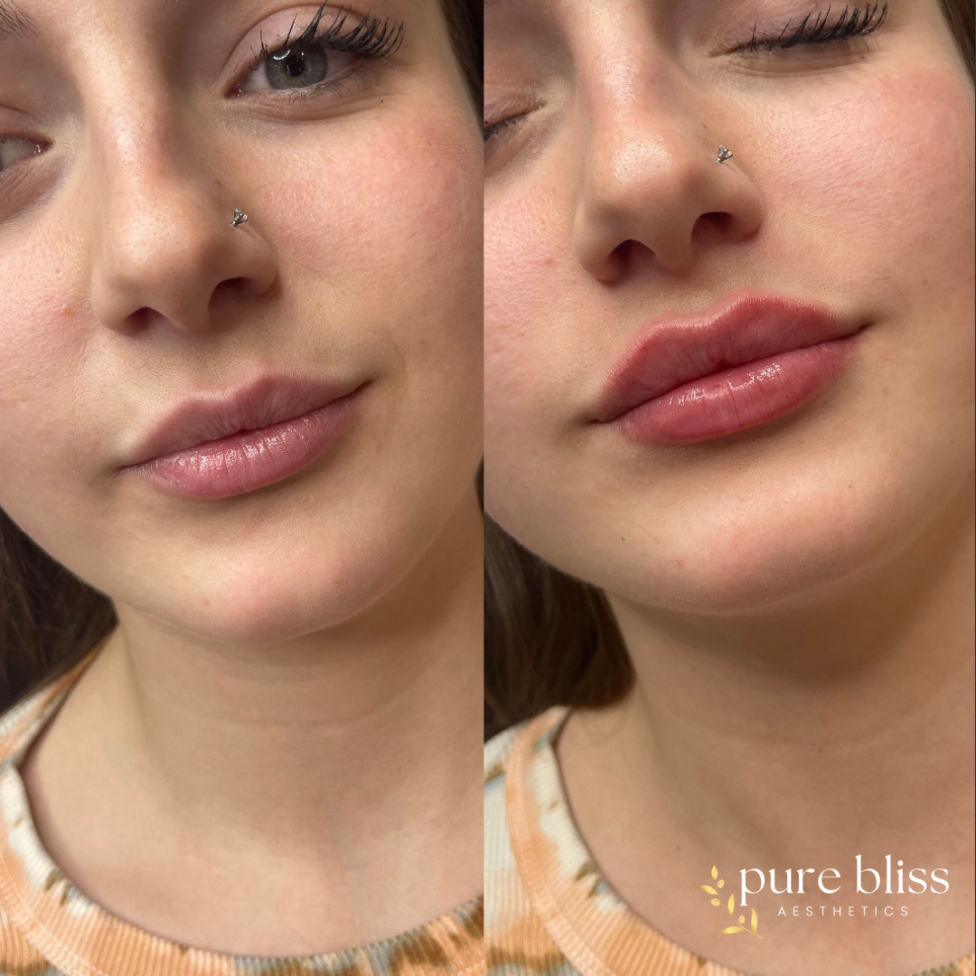 Lip filler before and after with 0.5ml of Restylane Kysse 