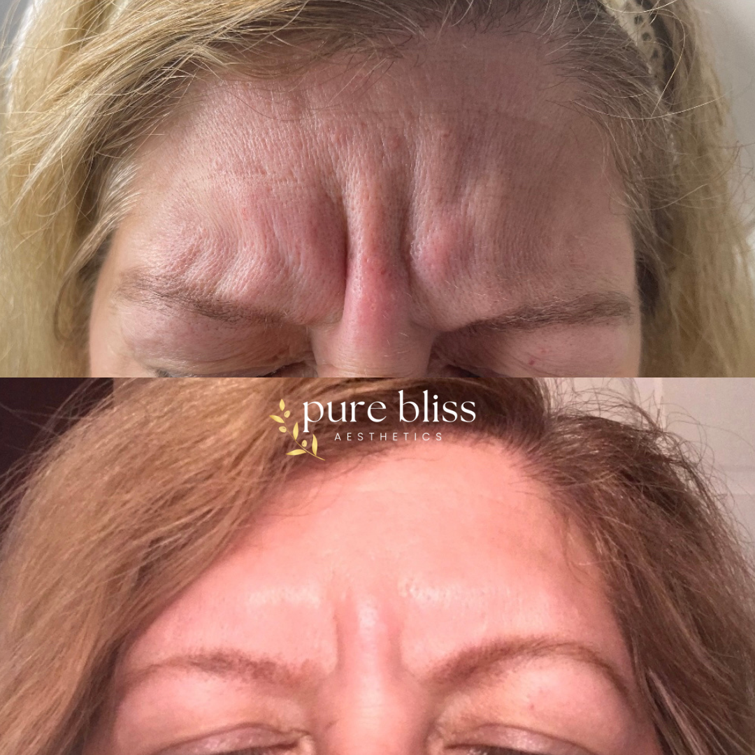 Close-up of forehead wrinkles before and after Botox treatment. Top shows deep frown lines, bottom shows smoothed skin after Dysport.