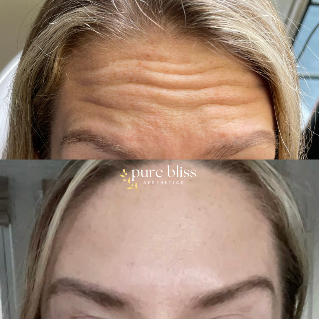 Before and after images showing the reduction of forehead wrinkles after Botox.