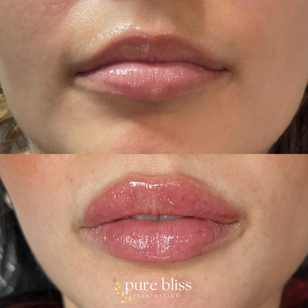 Lip filler built over time.