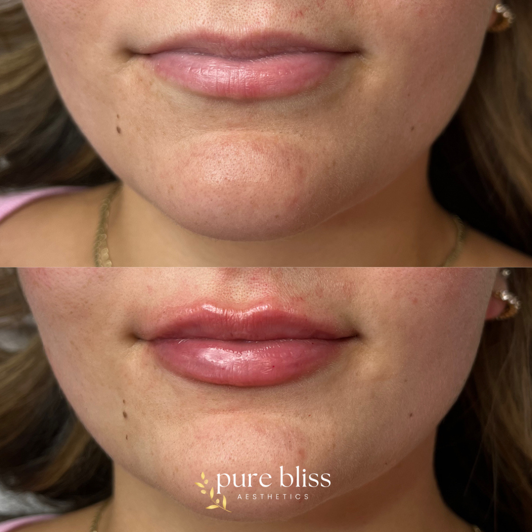 Lip filler before and after with 1ml of Revanesse Versa