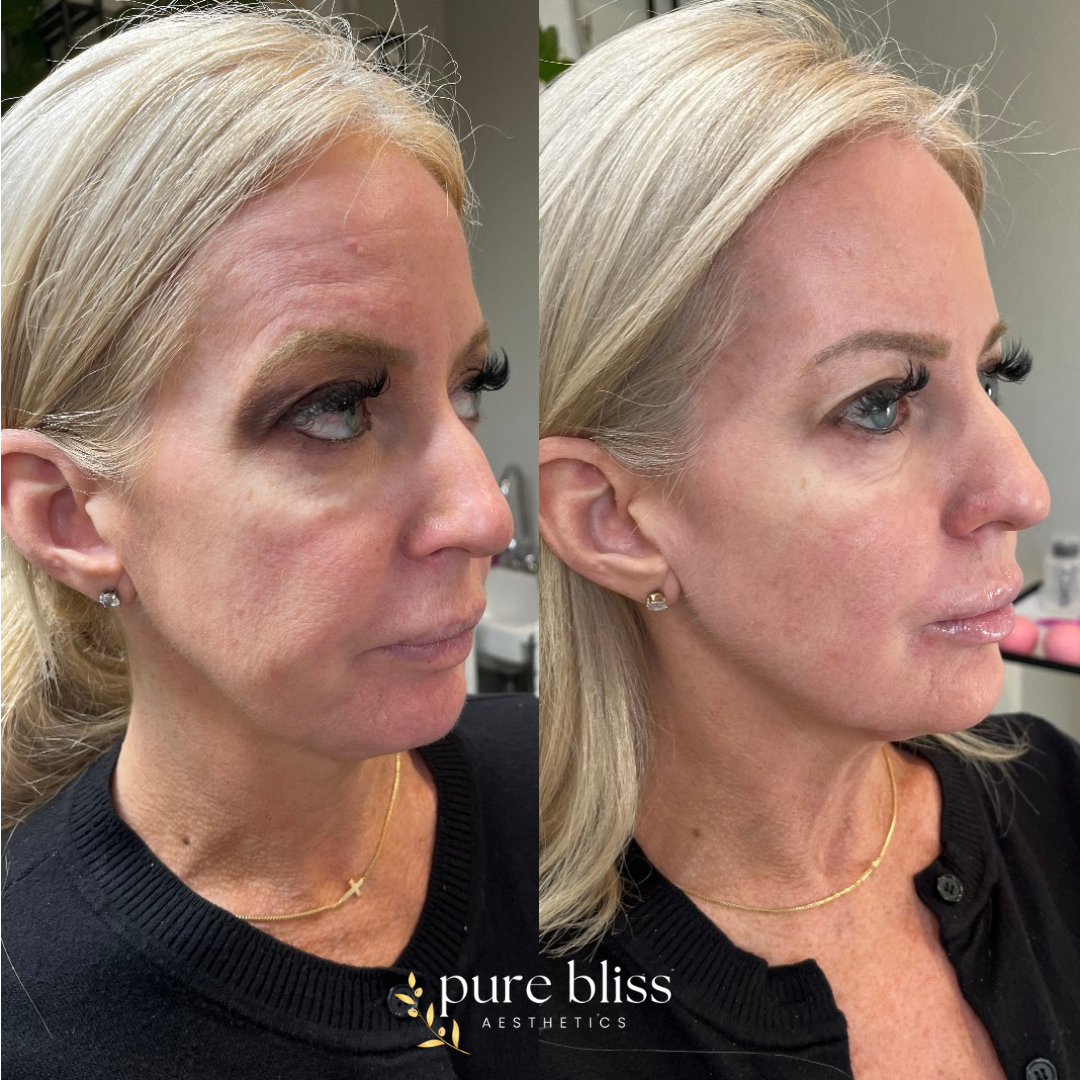 8 point lift before and after using dermal filler. Here we strategically placed 2ml of filler in the cheeks, chin, jawline, and nasolabial folds.
