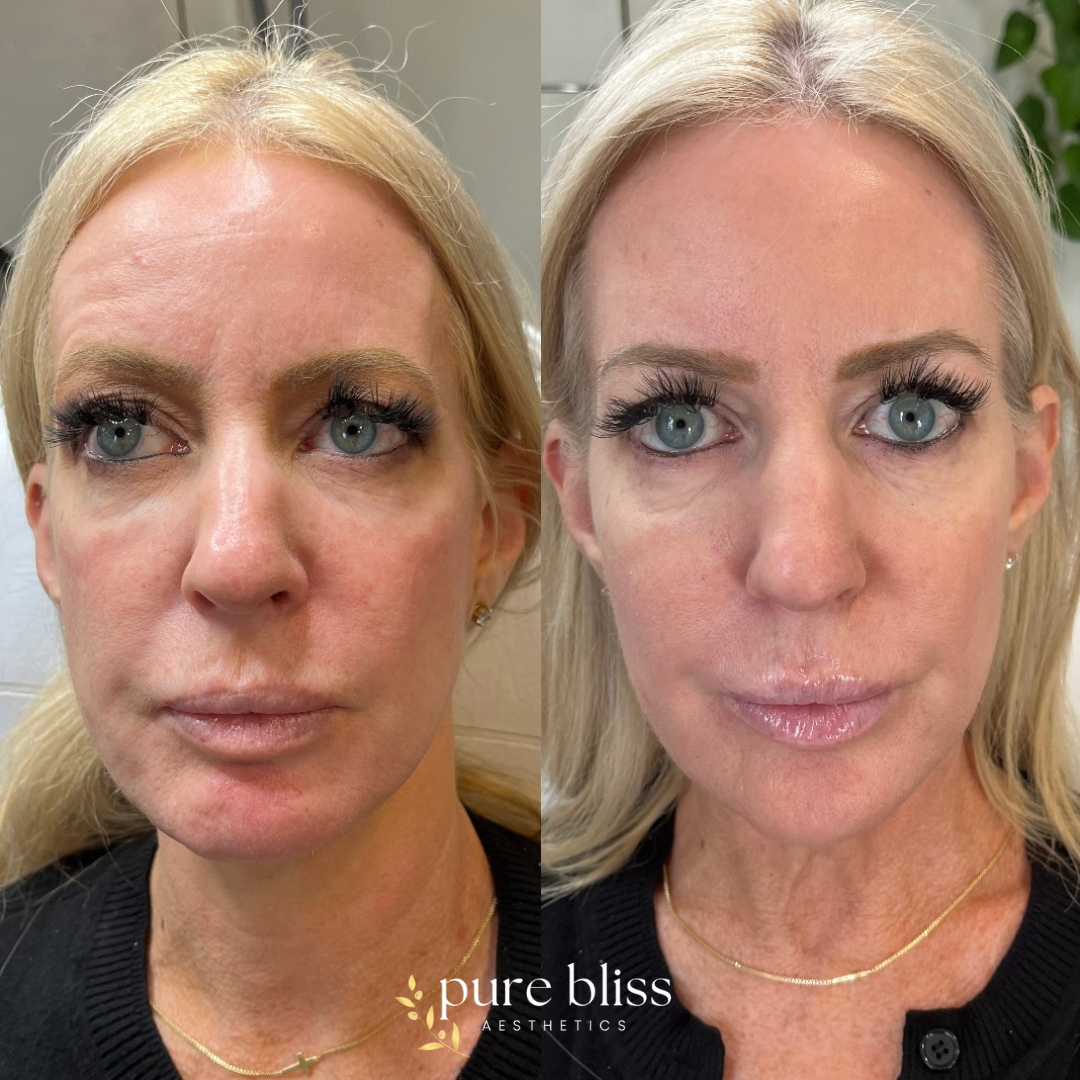 8 point lift before and after using dermal filler. Here we strategically placed 2ml of filler in the cheeks, chin, jawline, and nasolabial folds.