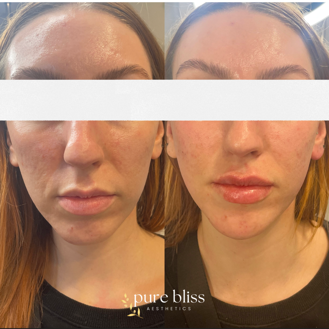 Filler before and after with 0.5ml of Restylane Kysse in the lips and 1ml of Restylane Defyne split up in the cheeks and chin.