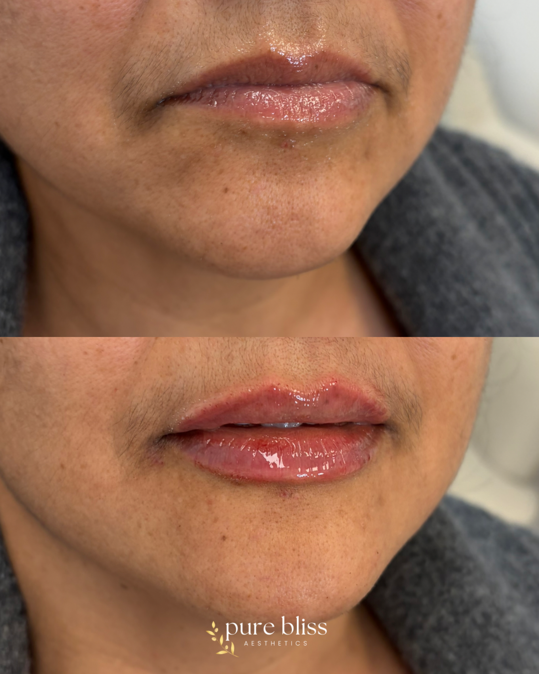 Half syringe of lip filler using 0.6ml Revanesse Versa.