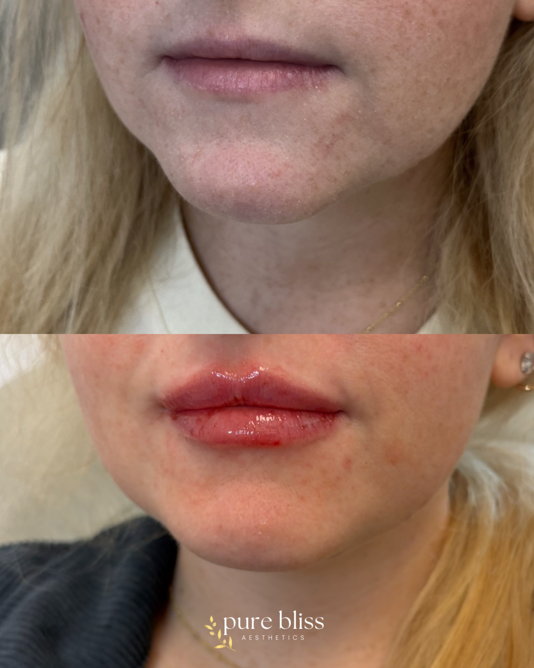 Half syringe of lip filler using 0.6ml Revanesse Versa.