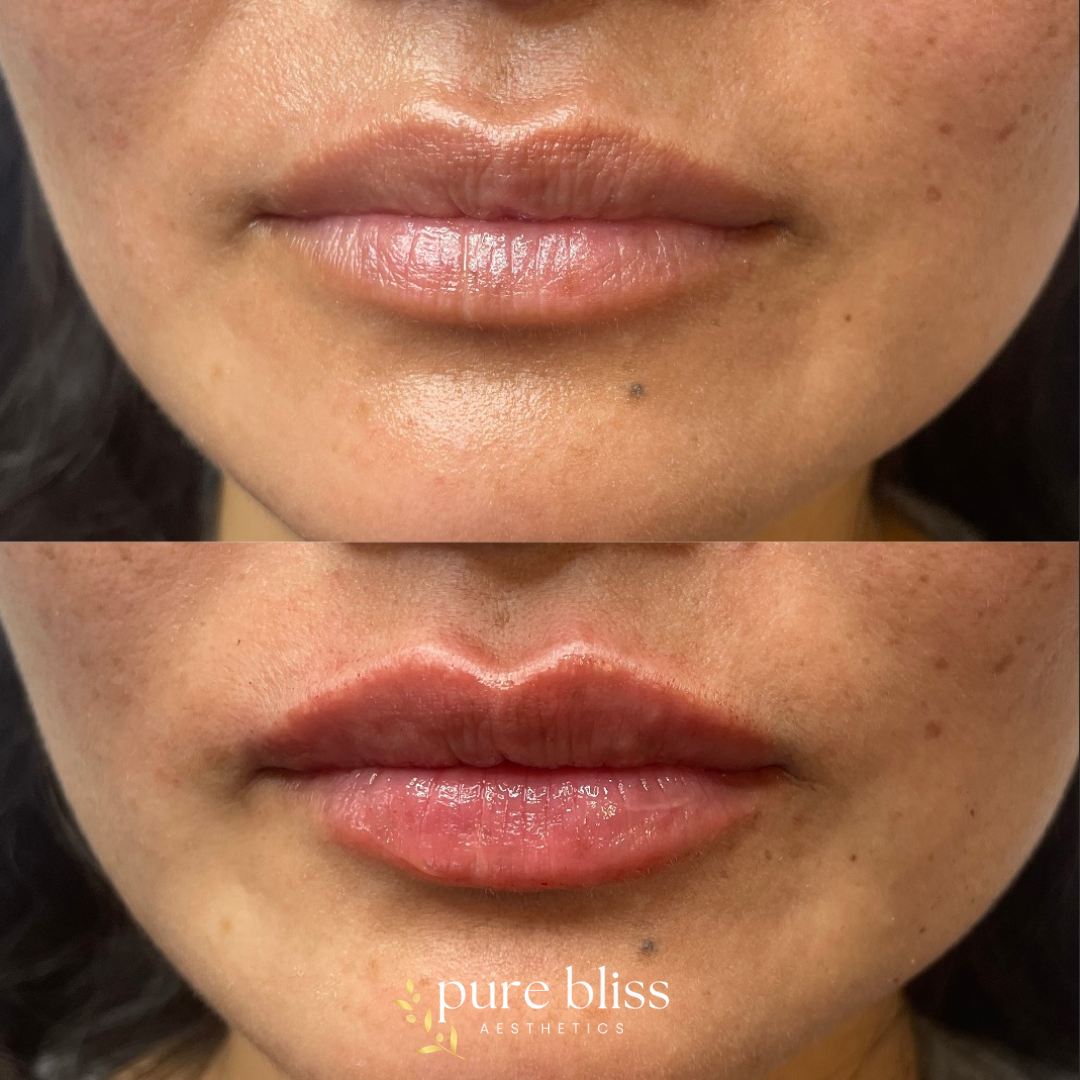 Lip filler before and after with 0.5ml of Restylane Kysse 