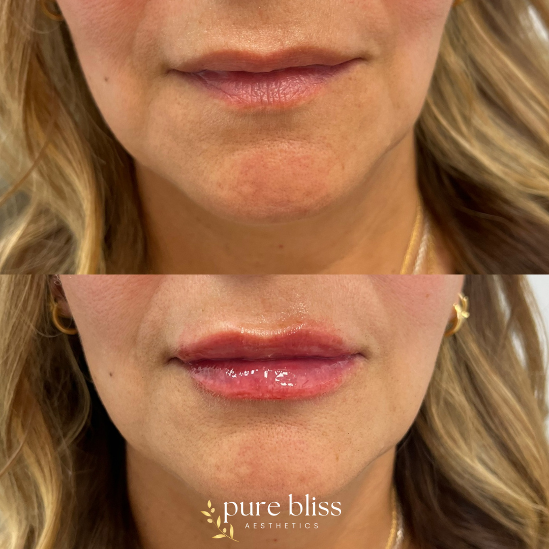 Lip filler before and after with 1.2ml Versa.