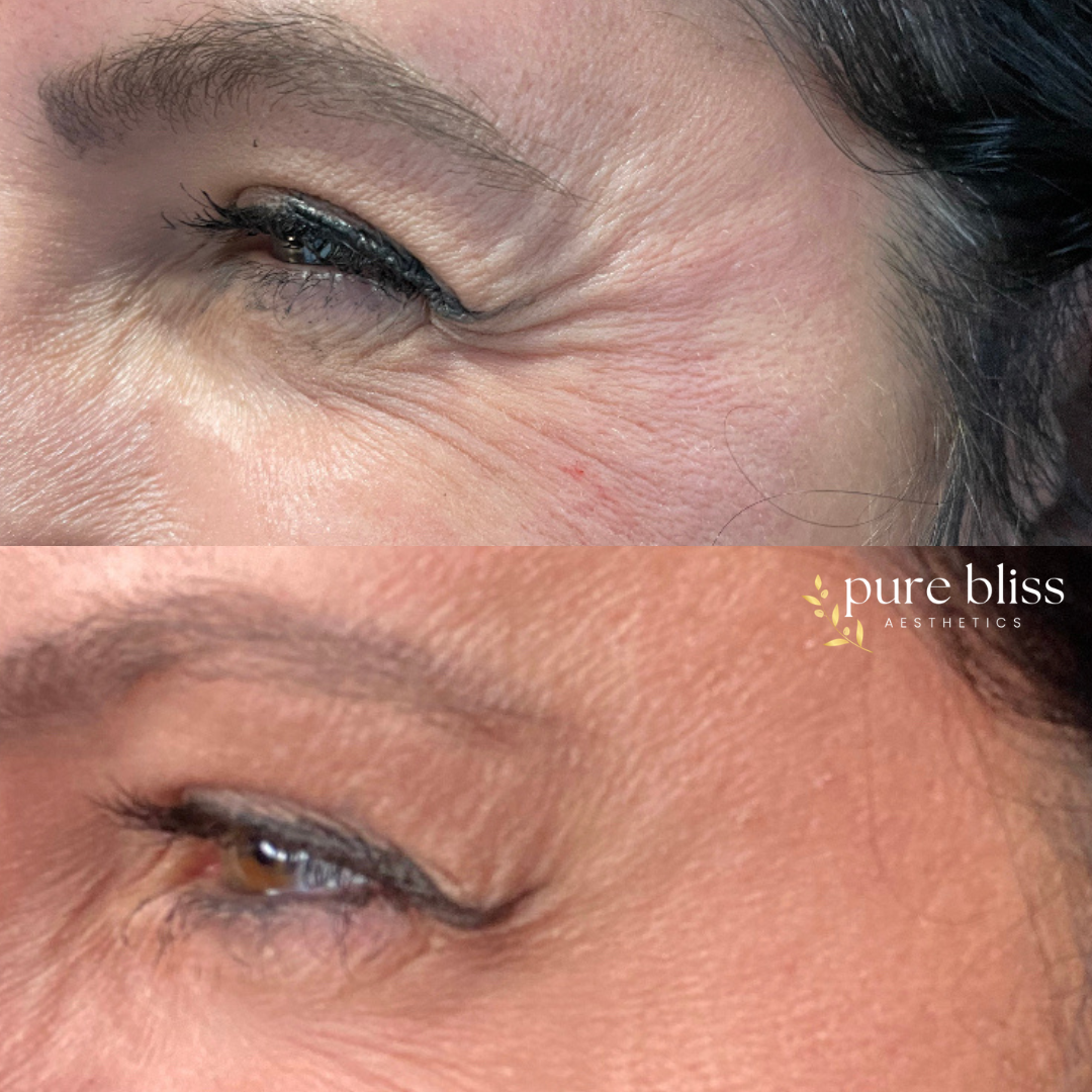 Close-up comparison of a person's eye area showing wrinkles before and after Botox treatment.