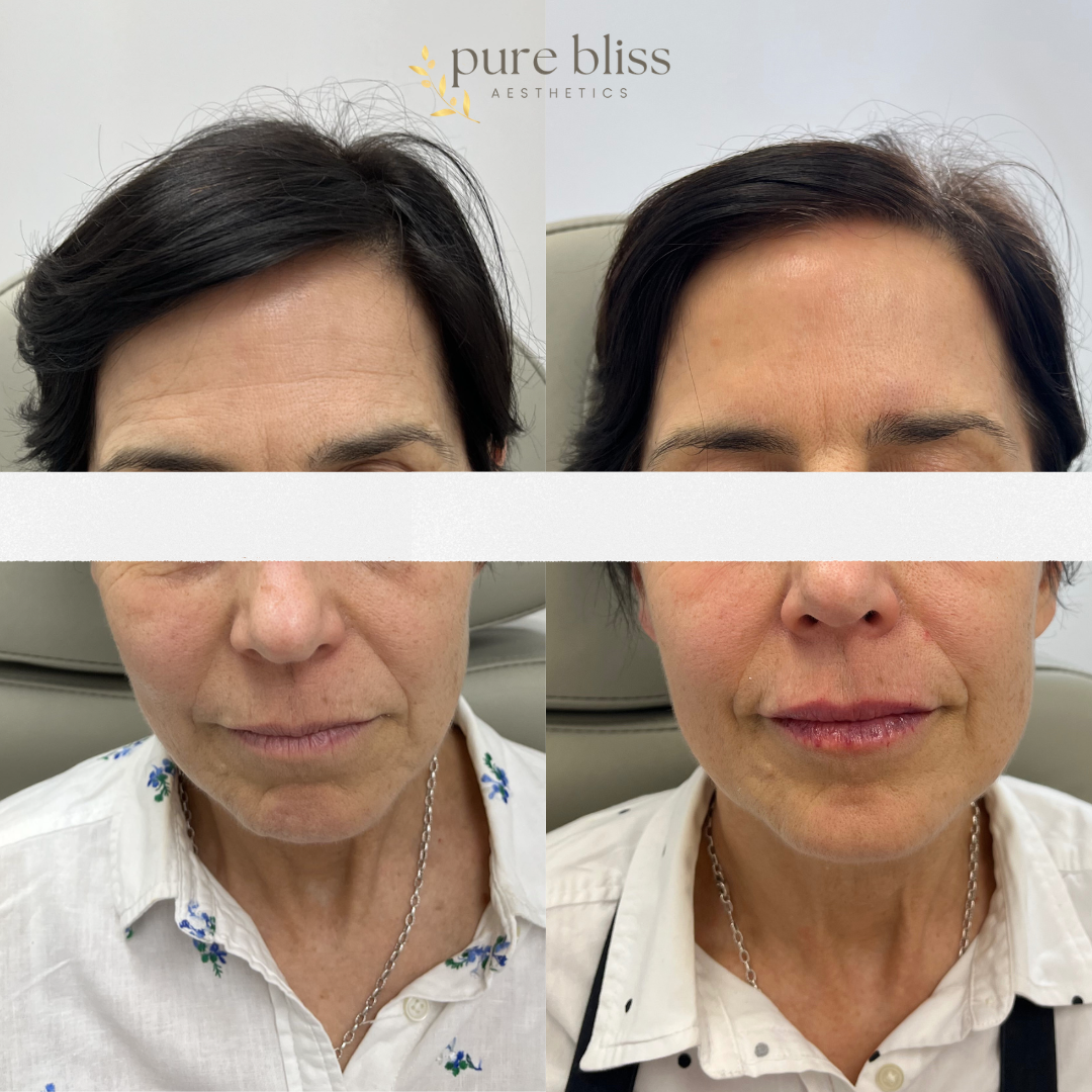 Full face dysport injections: forehead, labella, crows, chin, and DAOs.