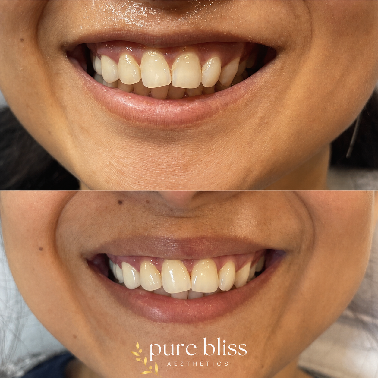 Comparison of a person's smile before and after a lip flip, showing a fuller top lip.