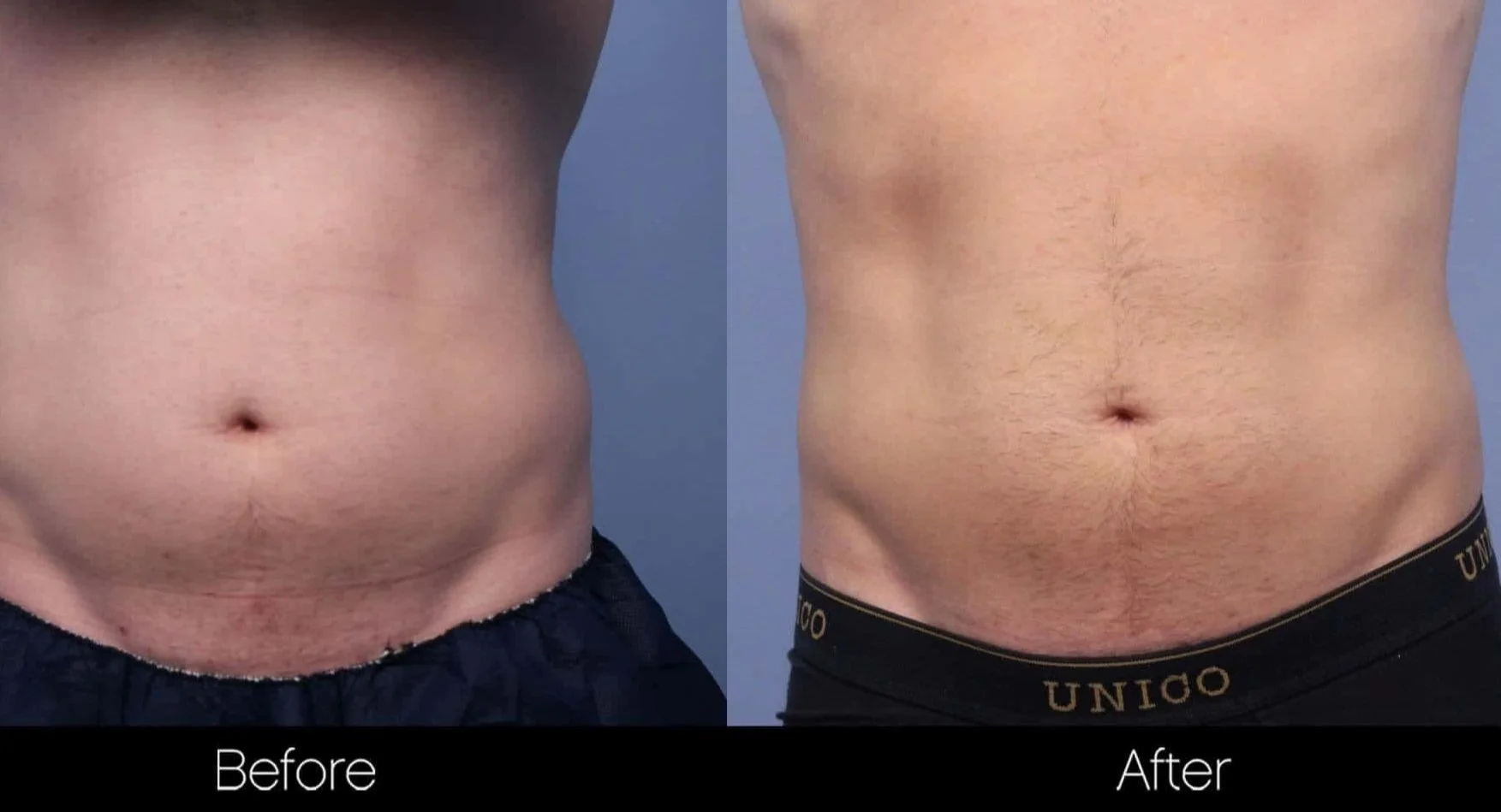 image39_non-surgical_body-contouring_evolve.jpg
