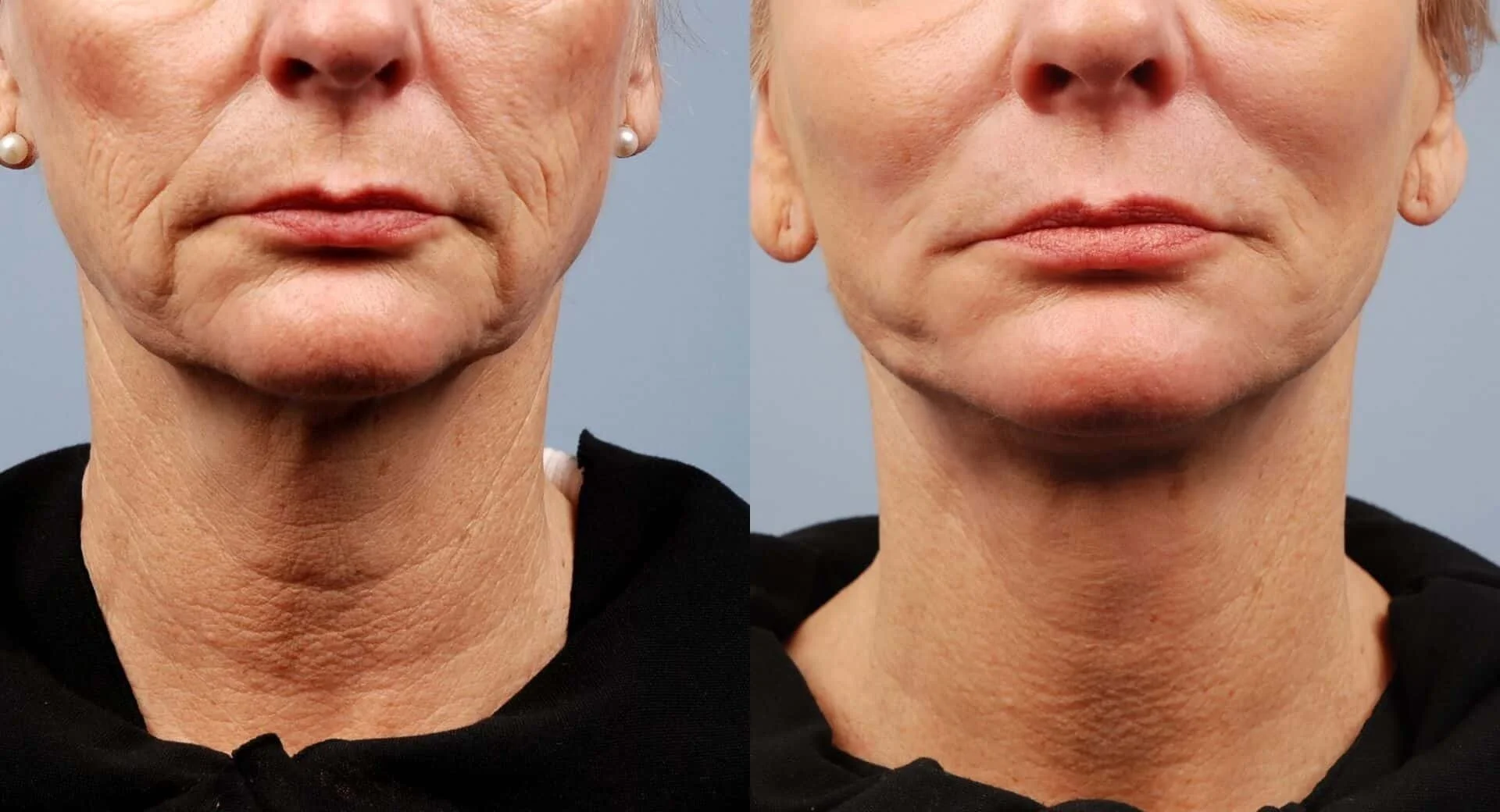 image19_non-surgical_laser-skin-treatmens_morpheus-1.jpg