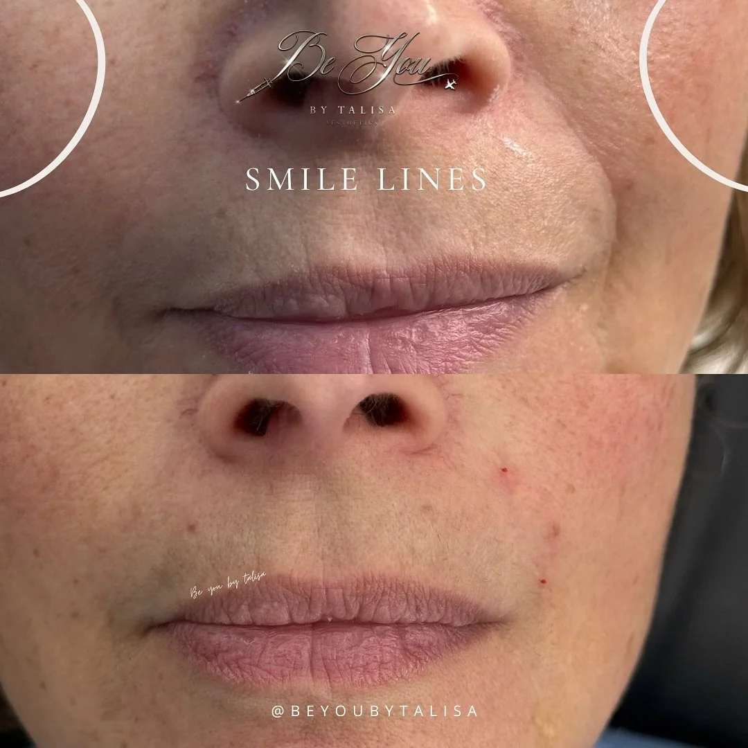 No lines here to see 

Treatment: Smile Lines - Dermal Filler 

🔞Must be over 18 years
💷 Non-refundable deposit required to book
🏡 Home clinic/mobile appointments 
🚨 Emergency and complications trained and cover areas 
🚑 Linked with a team of pr
