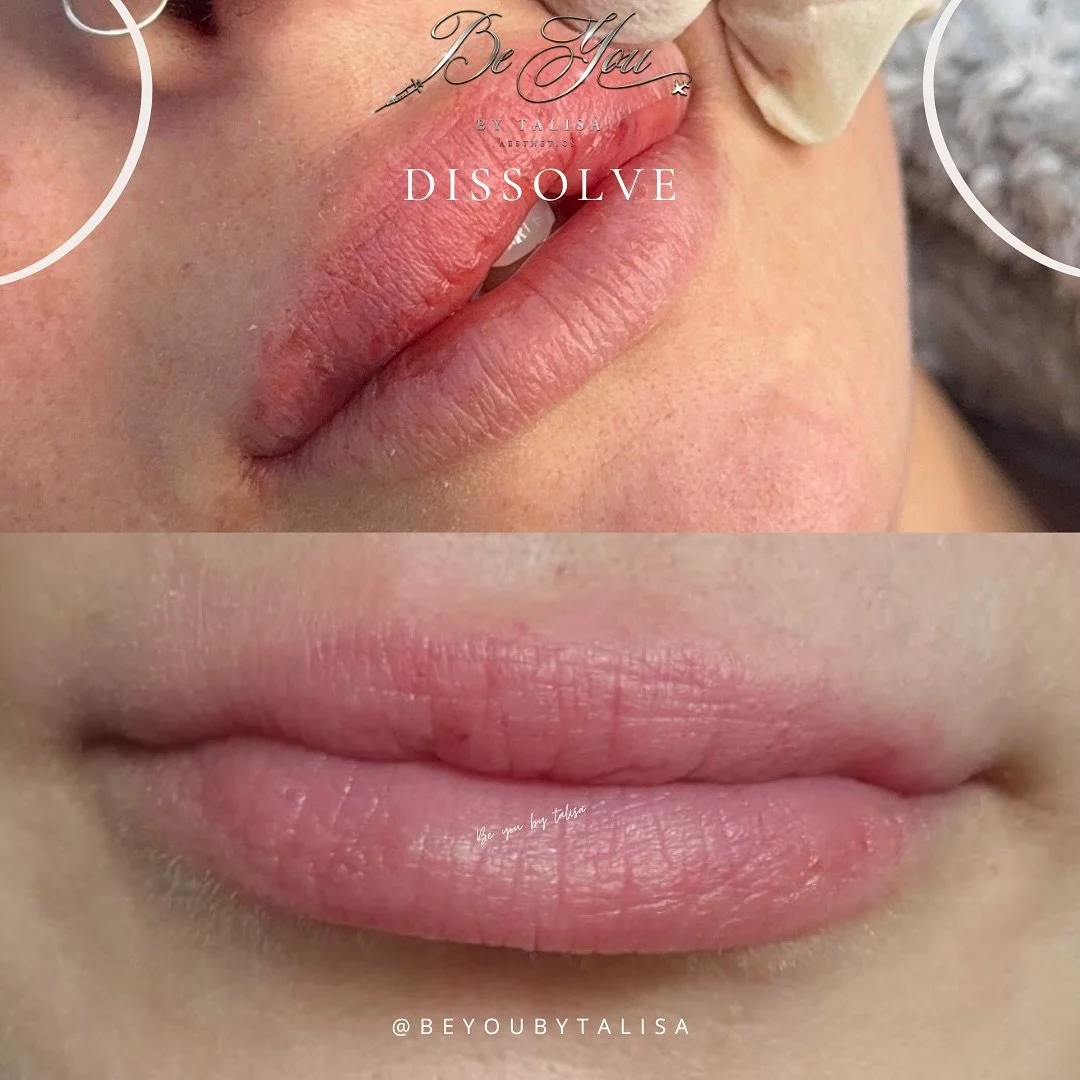 Step 1 of 2 

Treatment: Dissolve 

We decided to dissolve previous filler work due to migration and following the intradermal test being successful we administered Hyalurondaise to break down the filler - some slight swelling presented but the botto