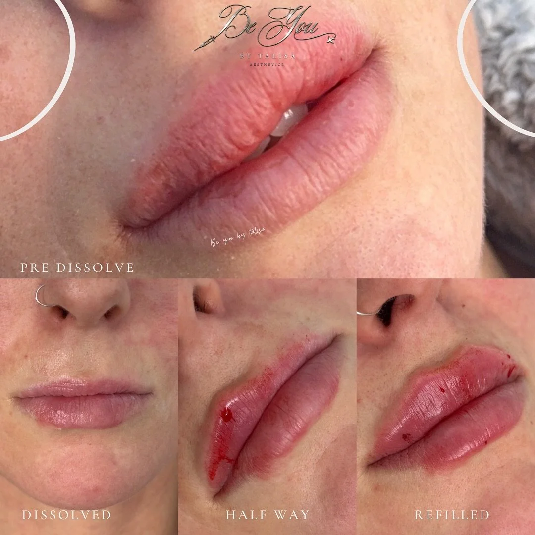 Starting fresh

Treatment: Dissolve and refill 

Patients lips had migrated from previous filler giving a uneven look - following a consultation it was decided that dissolving and starting again is the best option 

See the journey of treatment from 