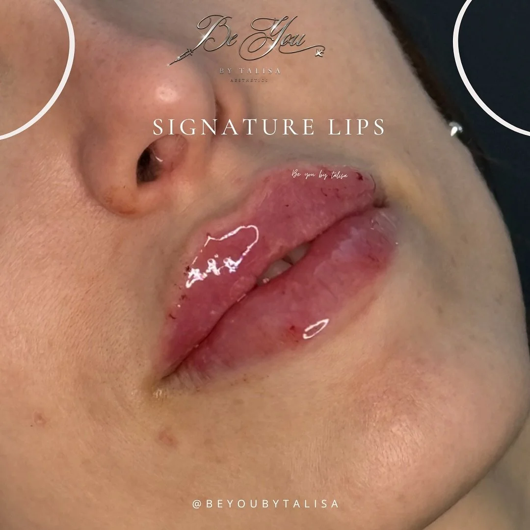 It&rsquo;s LIPS week and the signature style is giving 

Treatment: Signature lips 

🔞Must be over 18yrs
💷 Non refundable deposit required to book
🏡 Home clinic/mobile appointments 
🚨 Emergency and complications Trained and cover areas 
🚑 Linked