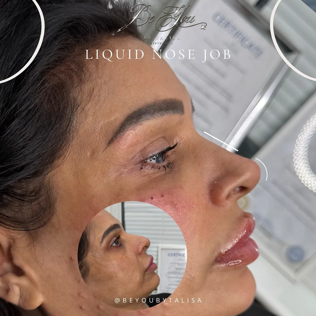 A non surgical rhinoplasty 

Treatment: Liquid Nose Job

🔞Must be over 18yrs
💷 Non refundable deposit required to book
🏡 Home clinic/mobile appointments 
🚨 Emergency and complications Trained and cover areas 
🚑 Linked with a team of Prescriber&r