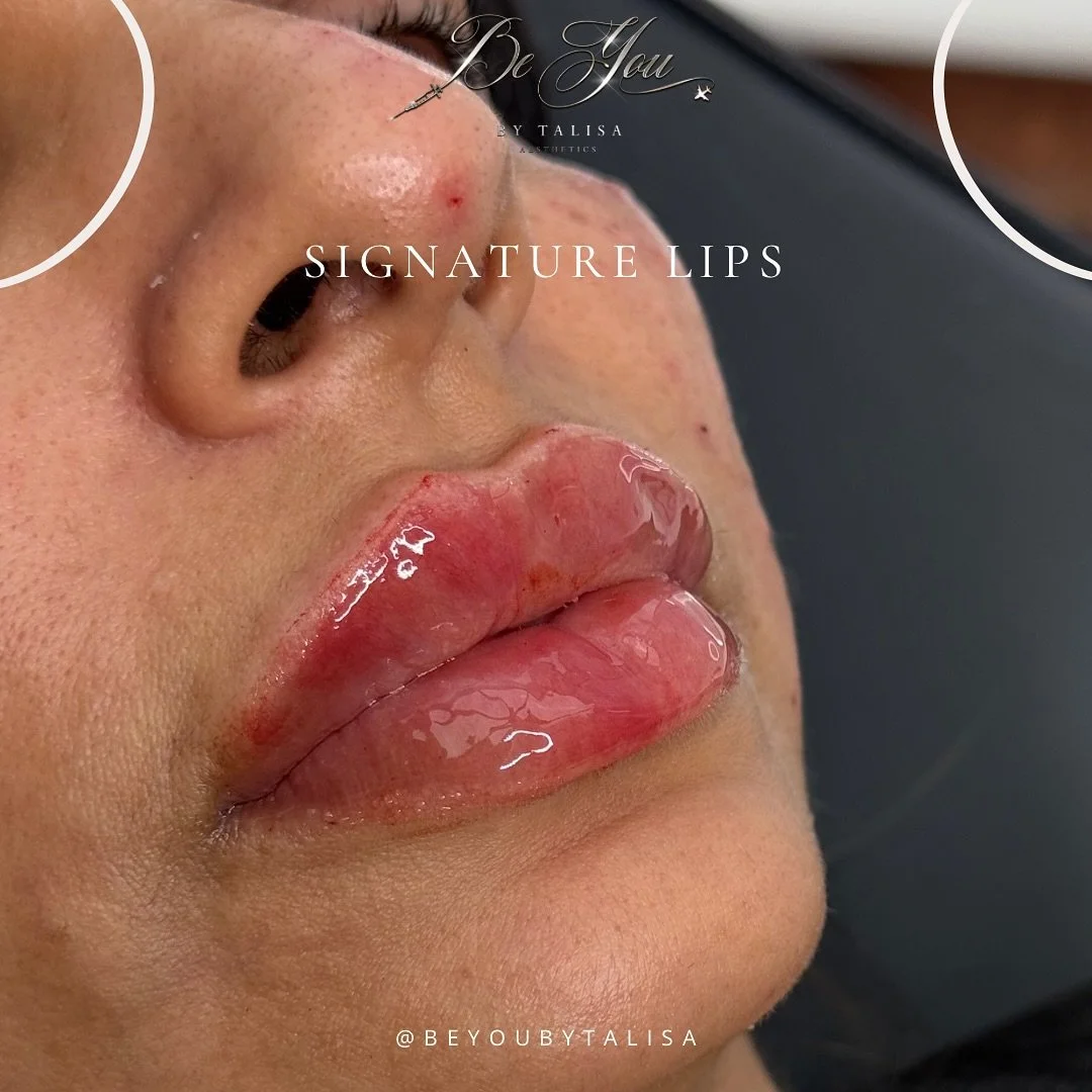 Take pout on me 💋- 

Treatment: Signature Lips 👄 

🔞Must be over 18yrs
💷 Non refundable deposit required to book
🏡 Home clinic/mobile appointments 
🚨 Emergency and complications Trained and cover areas 
🚑 Linked with a team of Prescriber&rsquo