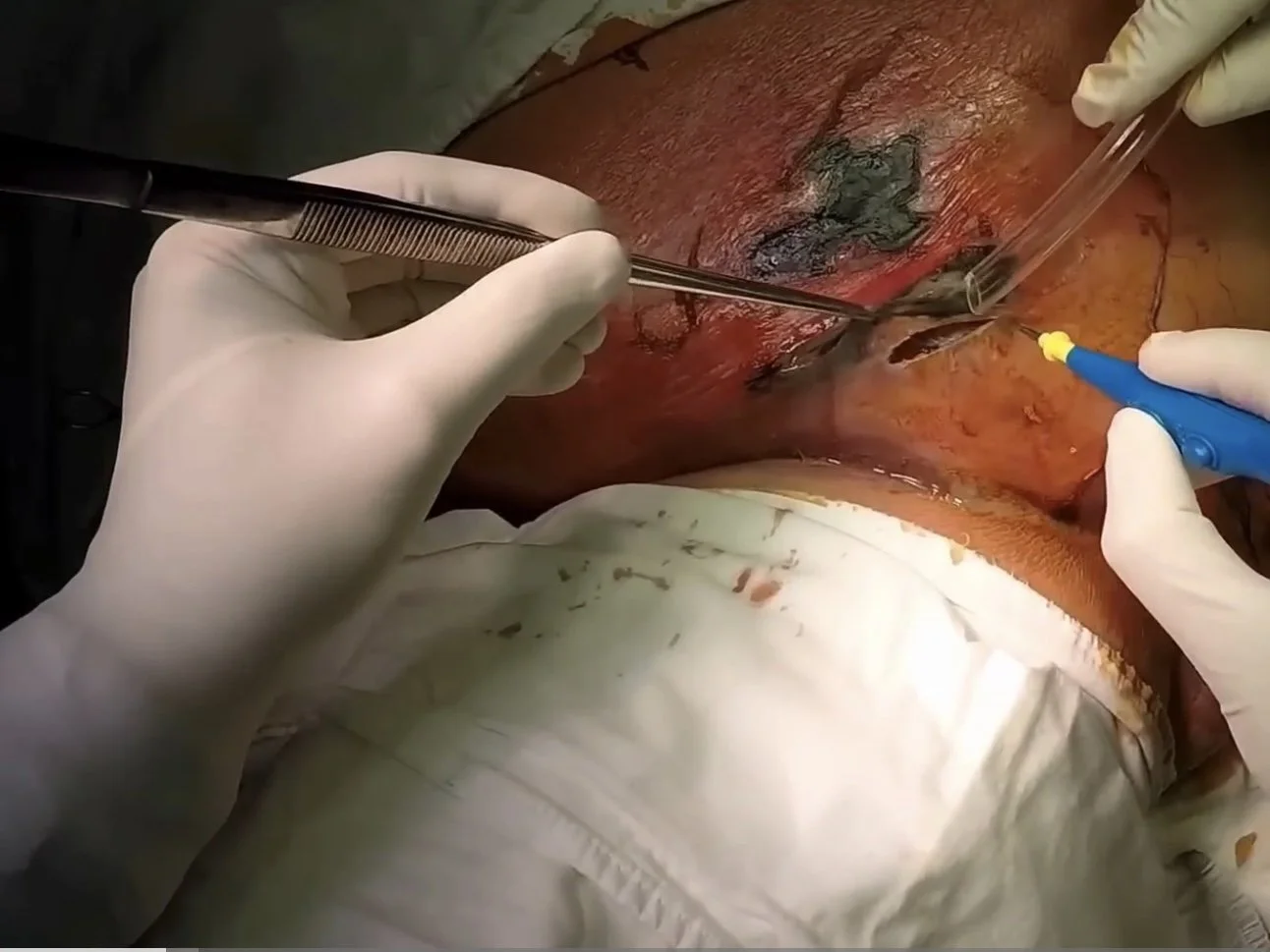 Urology - FG infection close-up