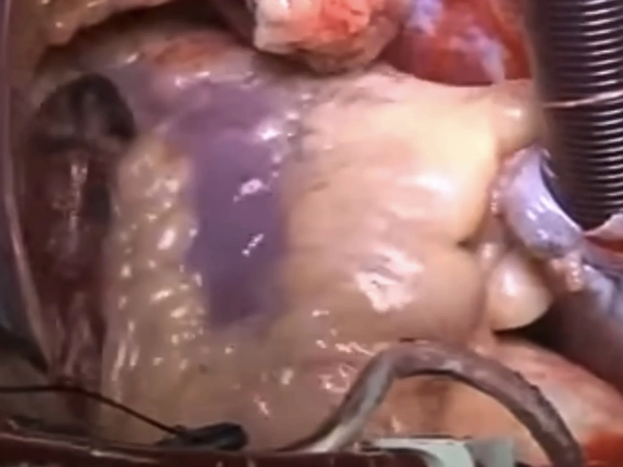 Heart flabby - LVEF is 16