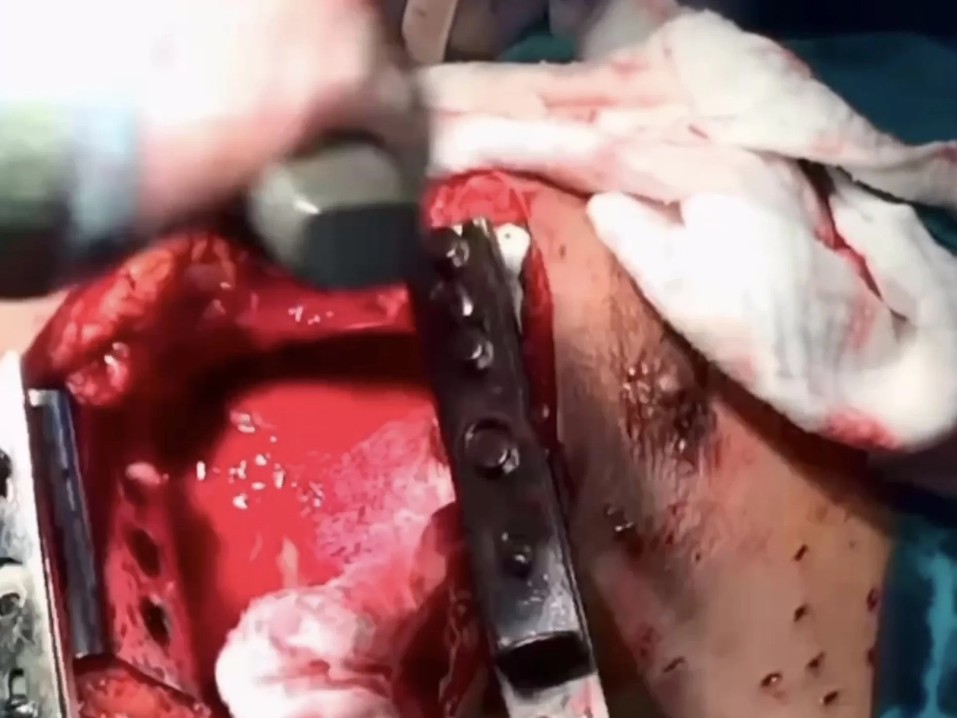 Re-opening chest using lebsche knife