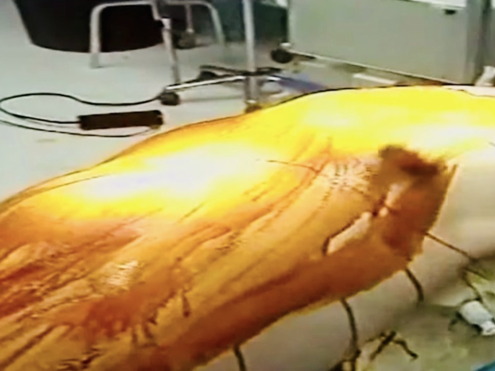 Prepping the patient's entire torso for surgery (neck to toes)