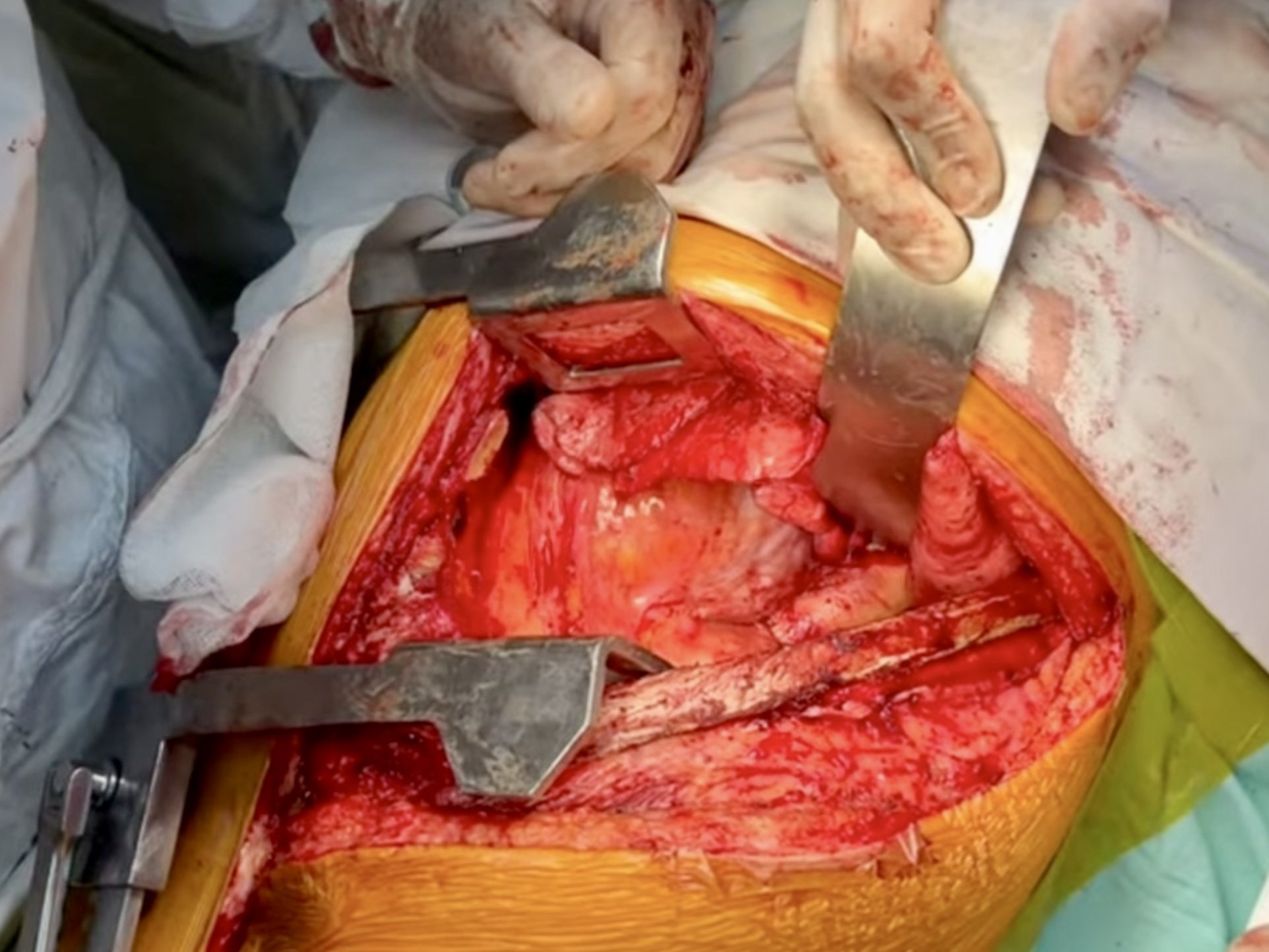 Cracking the patient open for adequate exposure using self-retaining retractors.
