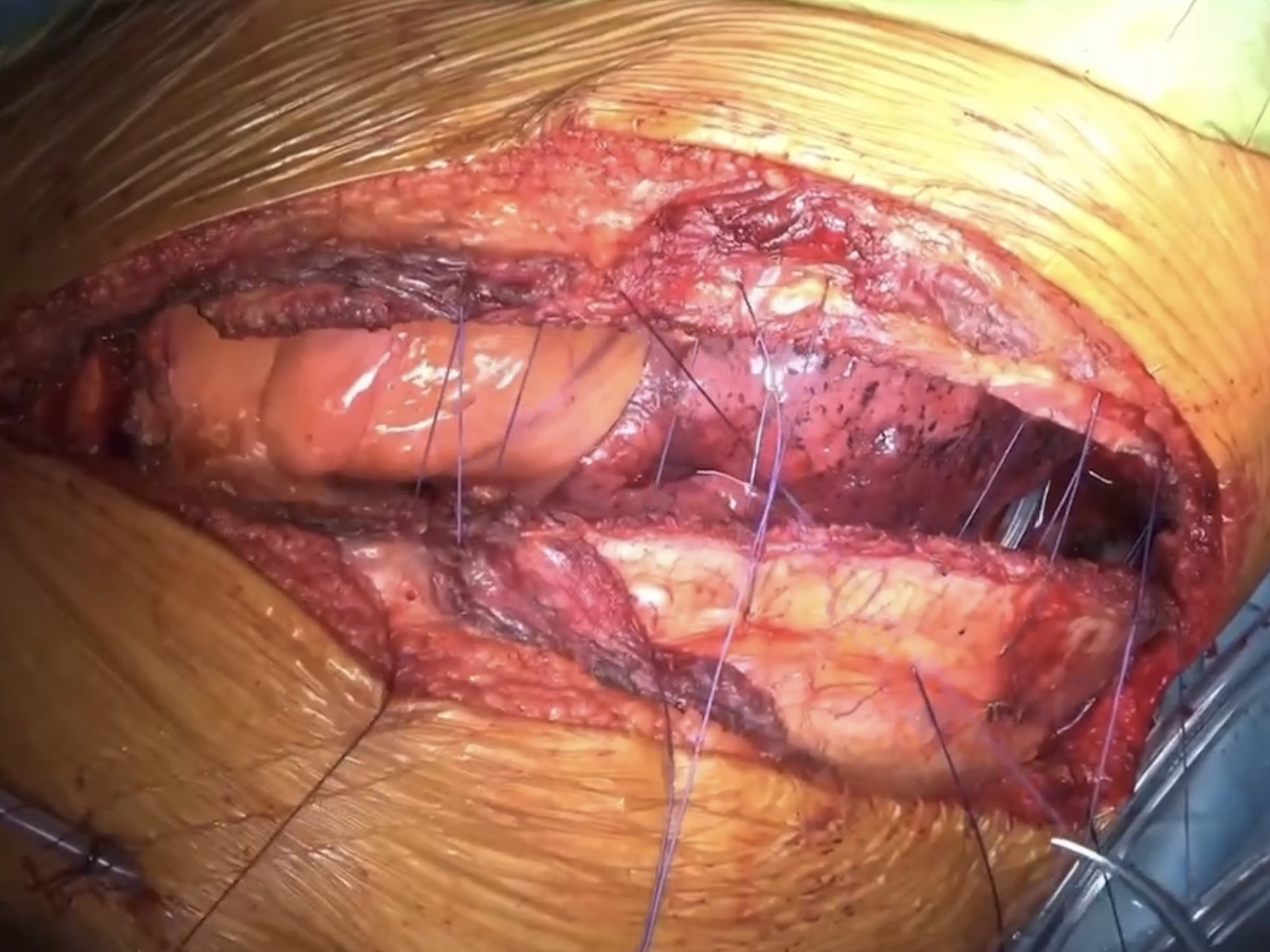 Closing the chest wall with thick-gauge needles. Post-operative pain has been described as unbearable.