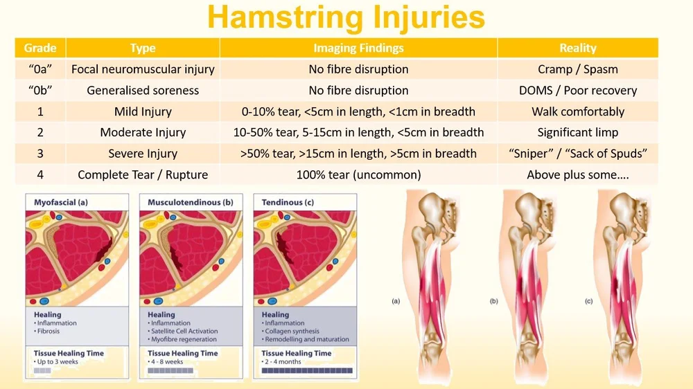 Hamstring Injuries — Rebound Rehabilitation