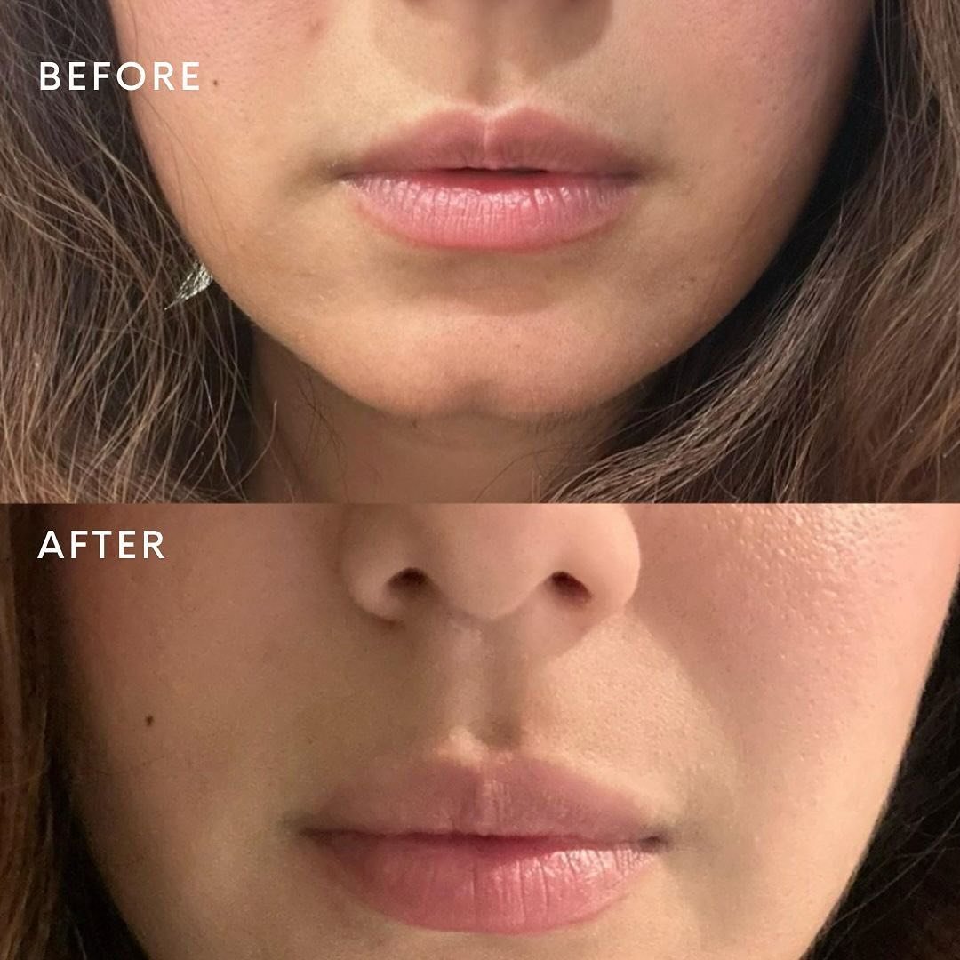 Lip Filler before &amp; afters 🩷💋

Just a couple of the lip transformations from our gorgeous clients. To get your dream lip shape, get in touch ✨

 📞 905-703-7546
📩 info@skincentrix.com
📲 DM us!
.
.
.
#lipfiller #lipbotox #lipshape #botoxtreatm