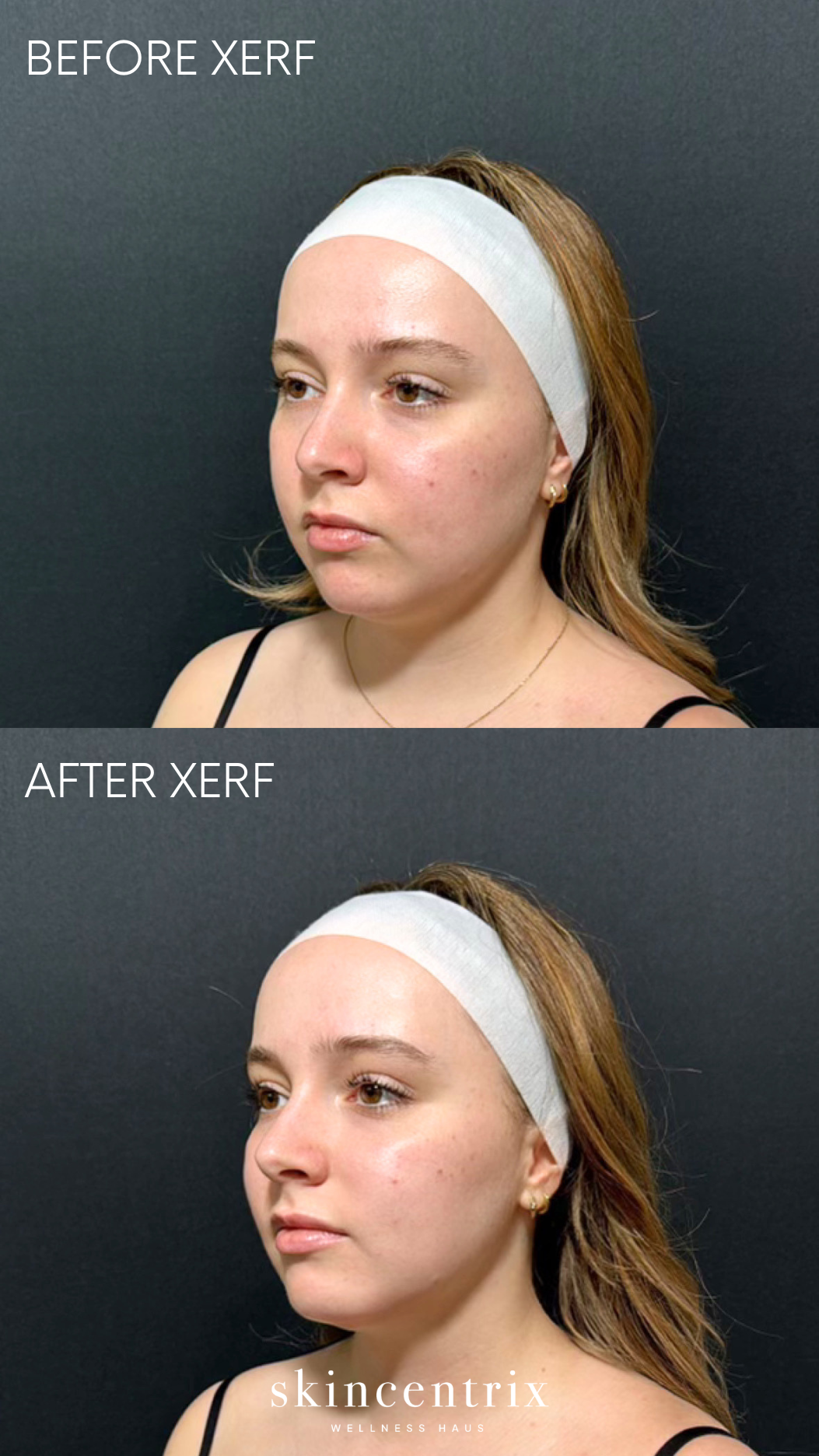 BEFORE AFTER XERF (1).png