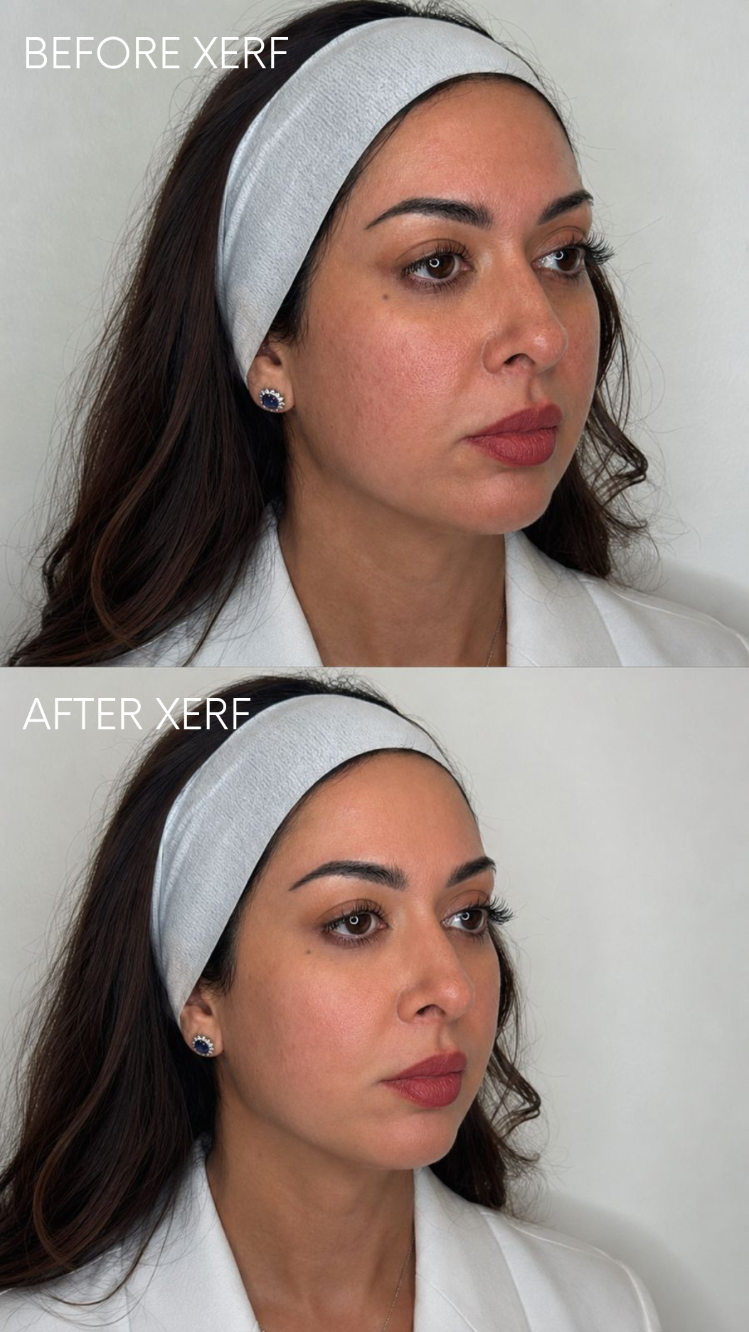 BEFORE AFTER XERF (3).png