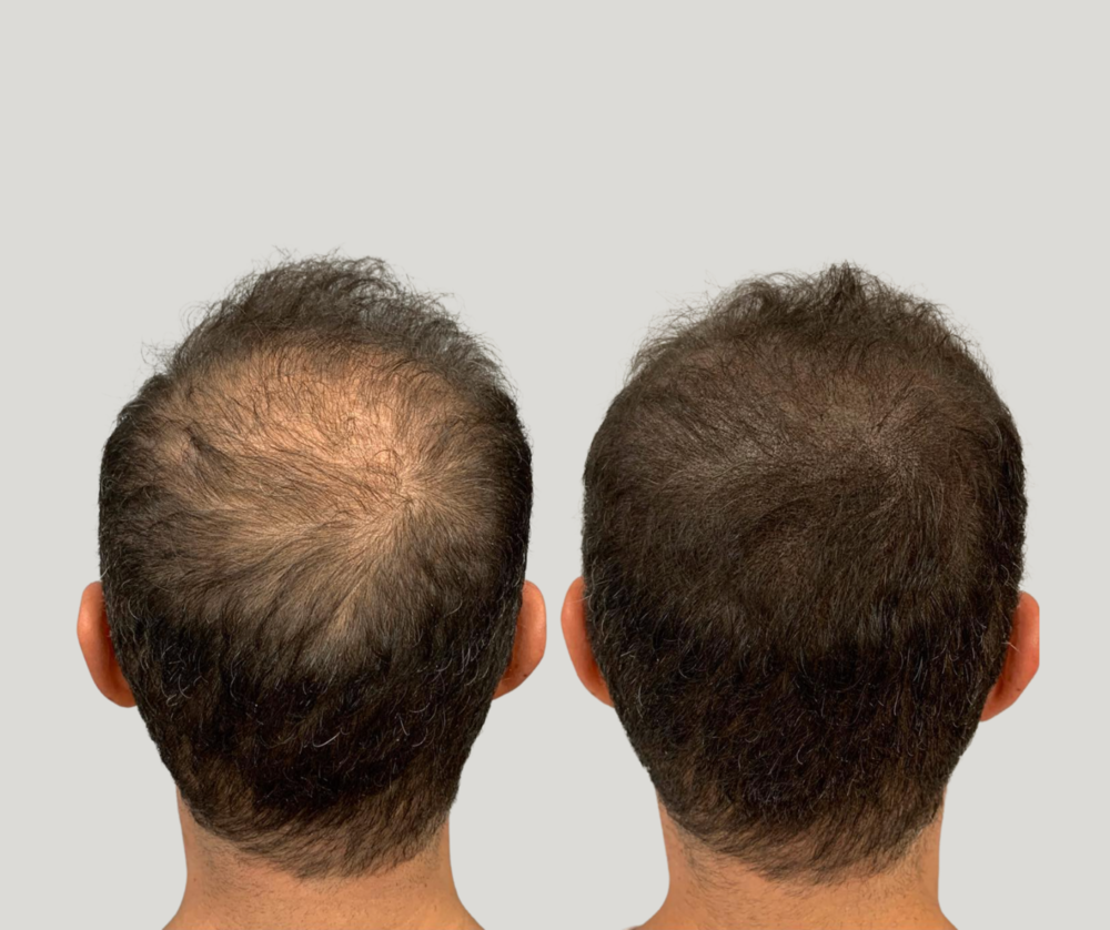 HAIR RESTORE LA - HAIR DENSITY — HAIR RESTORE LA HAIR RESTORE LA - HAIR DENSITY — HAIR RESTORE LA