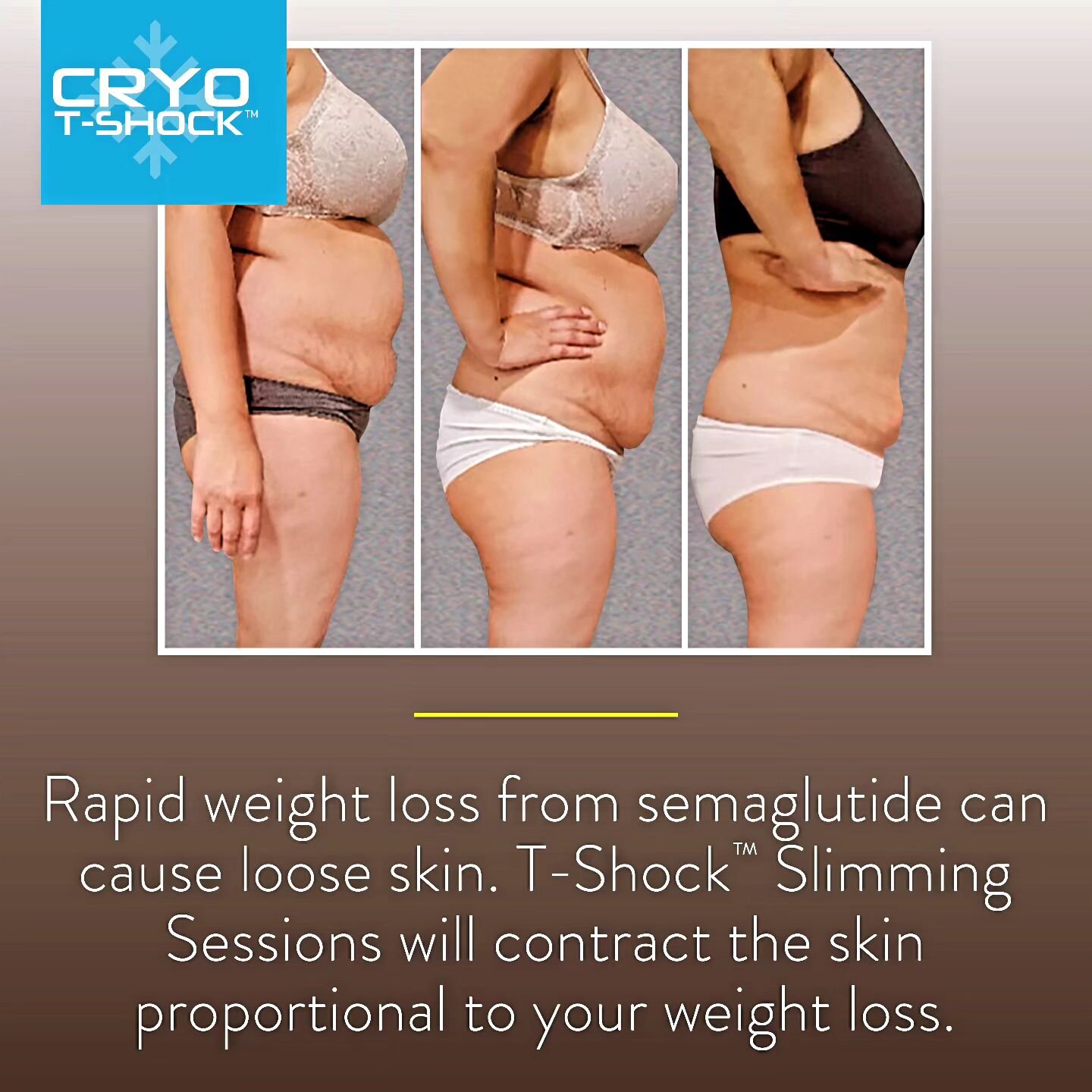 Are you in the process of losing weight? Worried about loose skin ? No need to worry the CRYO T  SHOCK  can help contract the loose skin portportional to your weight loss so no need for surgery once you have the weight off !

#weightlossjourney #loos