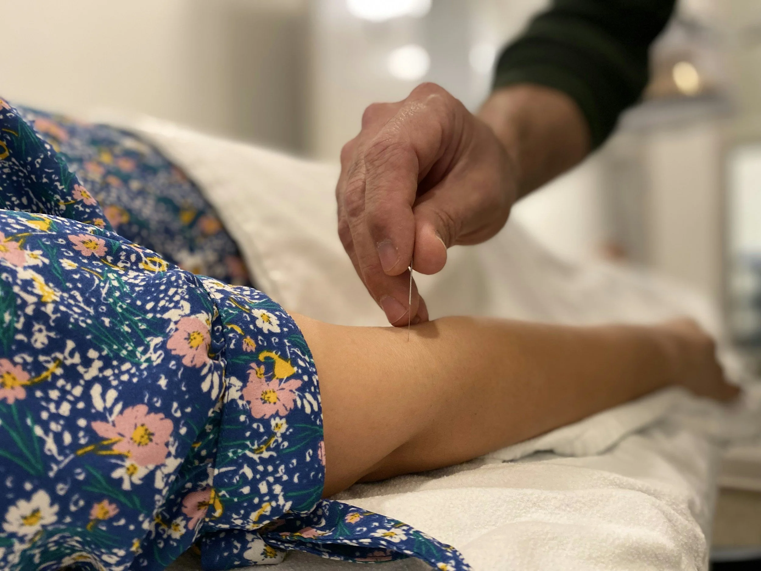 Dry needling treatment being performed on the lower leg as part of physical therapy care.