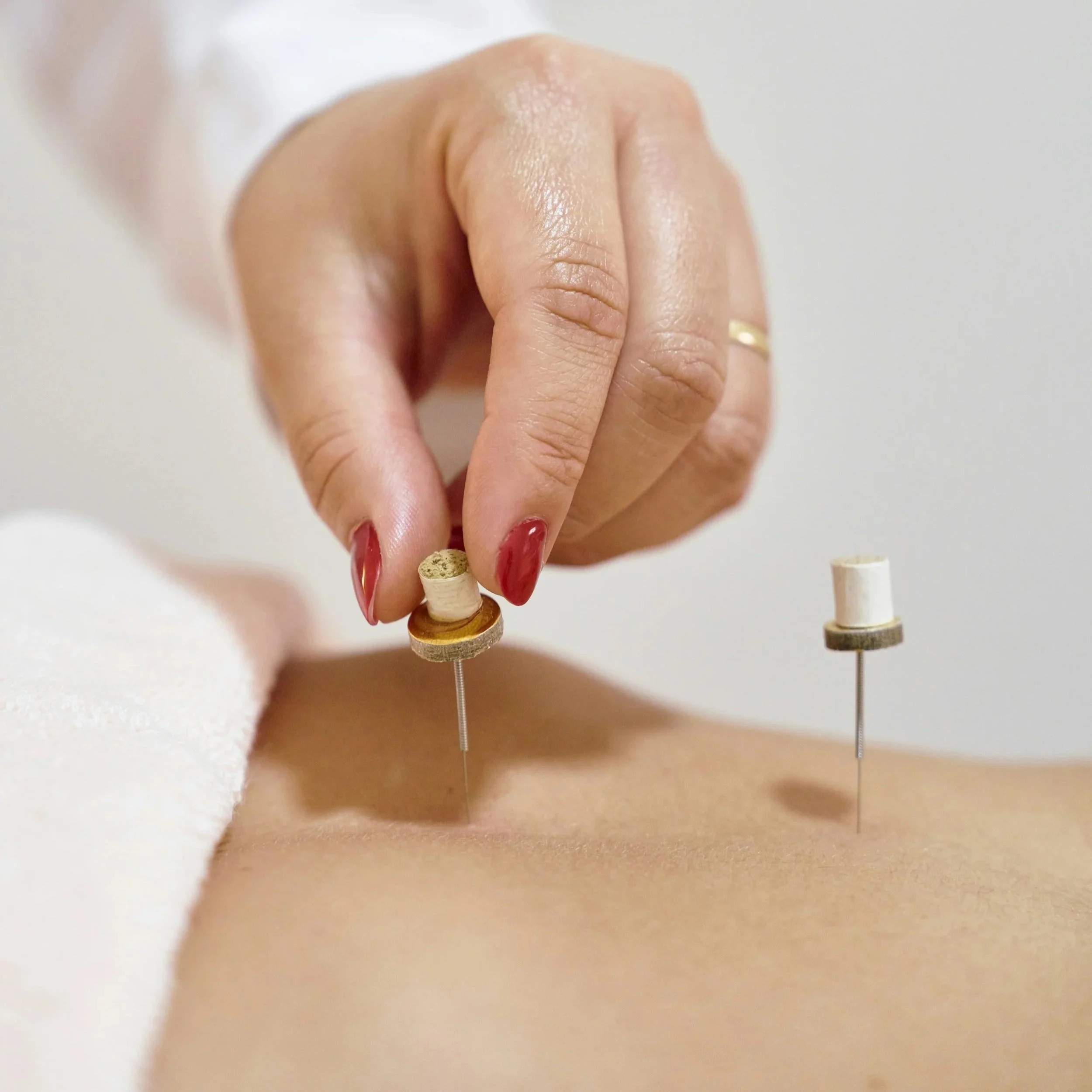 Close-up of a person receiving acupuncture treatment on their back, with fine needles inserted into the skin and one hand adjusting a small device.