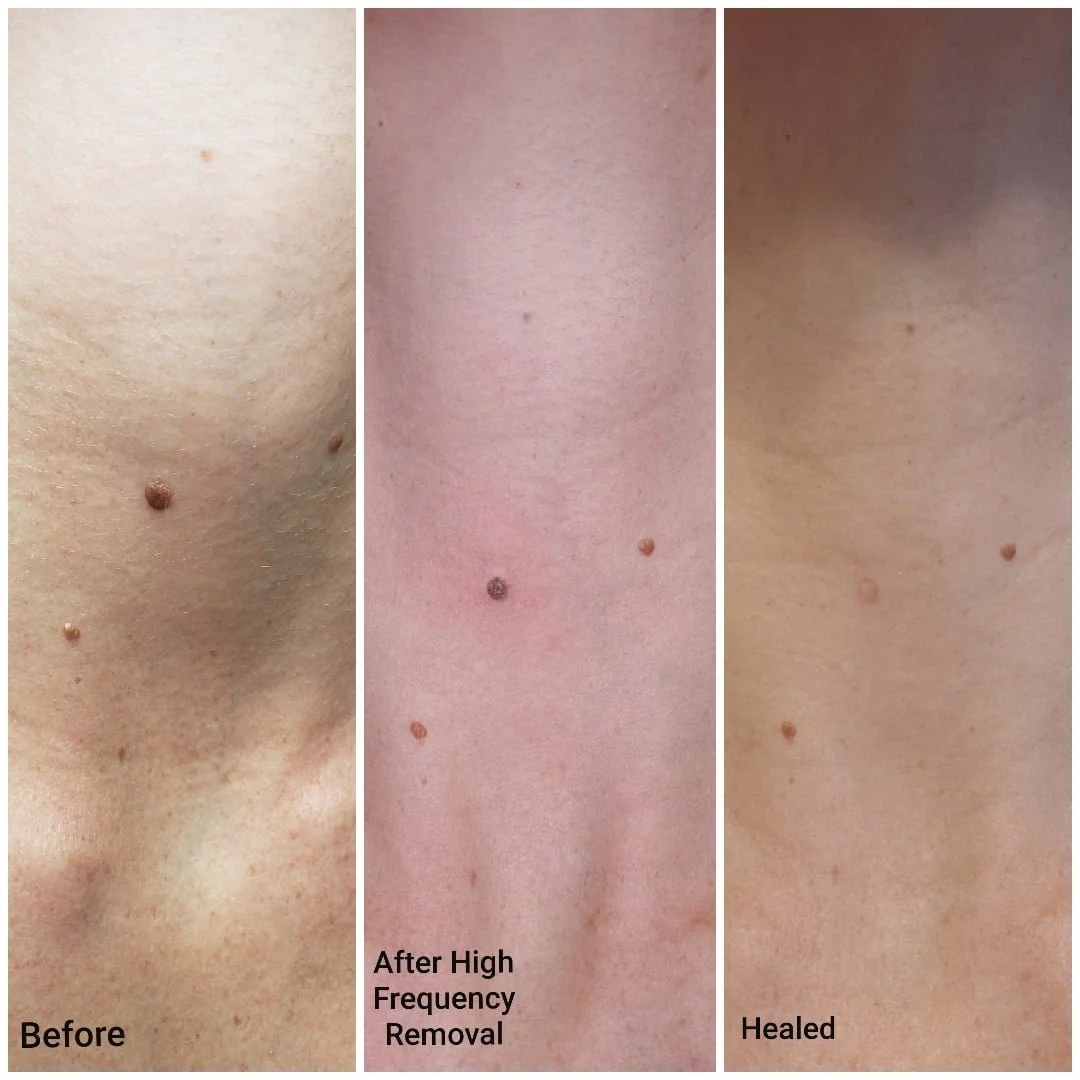 Skin-Growth-Removal.jpg