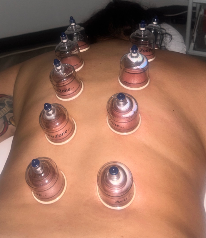 Back of a person lying face down on a massage table, receiving cupping therapy with multiple cups placed along their back.