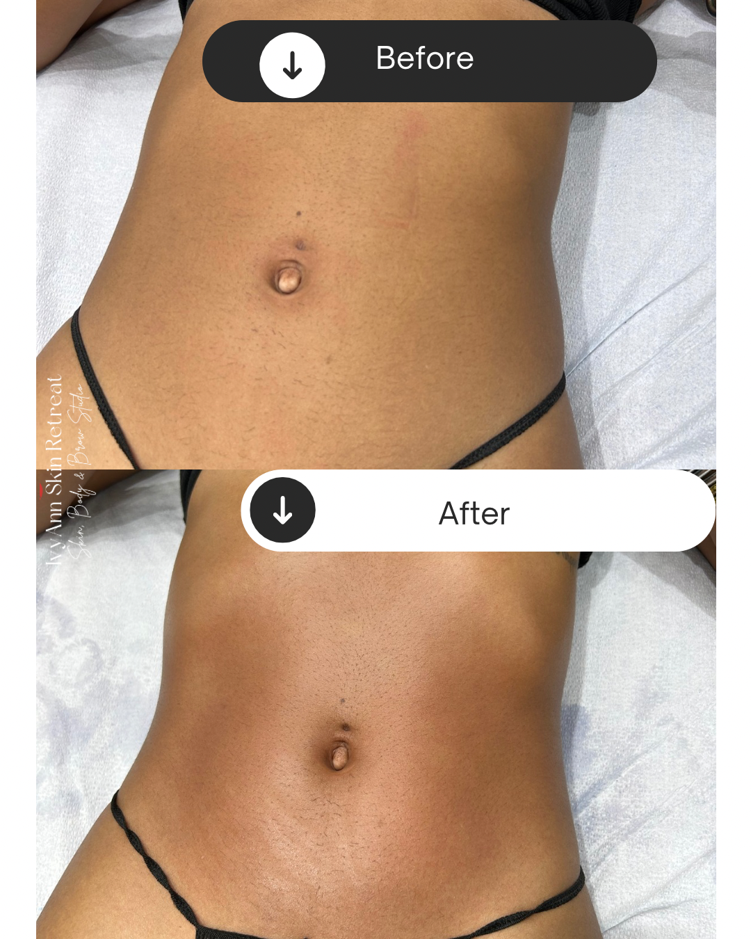 Comparison of a person's abdomen before and after a skin rejuvenation treatment, showing smoother skin in the after image.