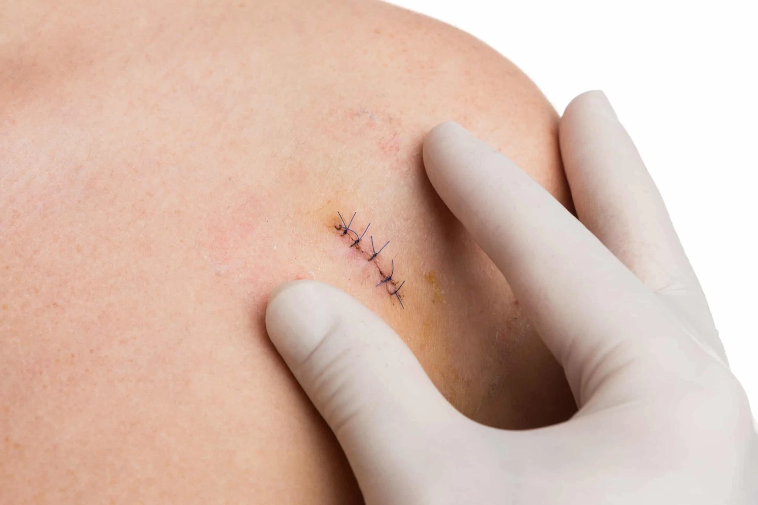Suture from surgery
