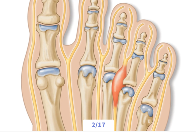 Illustration of human finger joints showing a healthy joint and one injured joint with inflammation or damage.