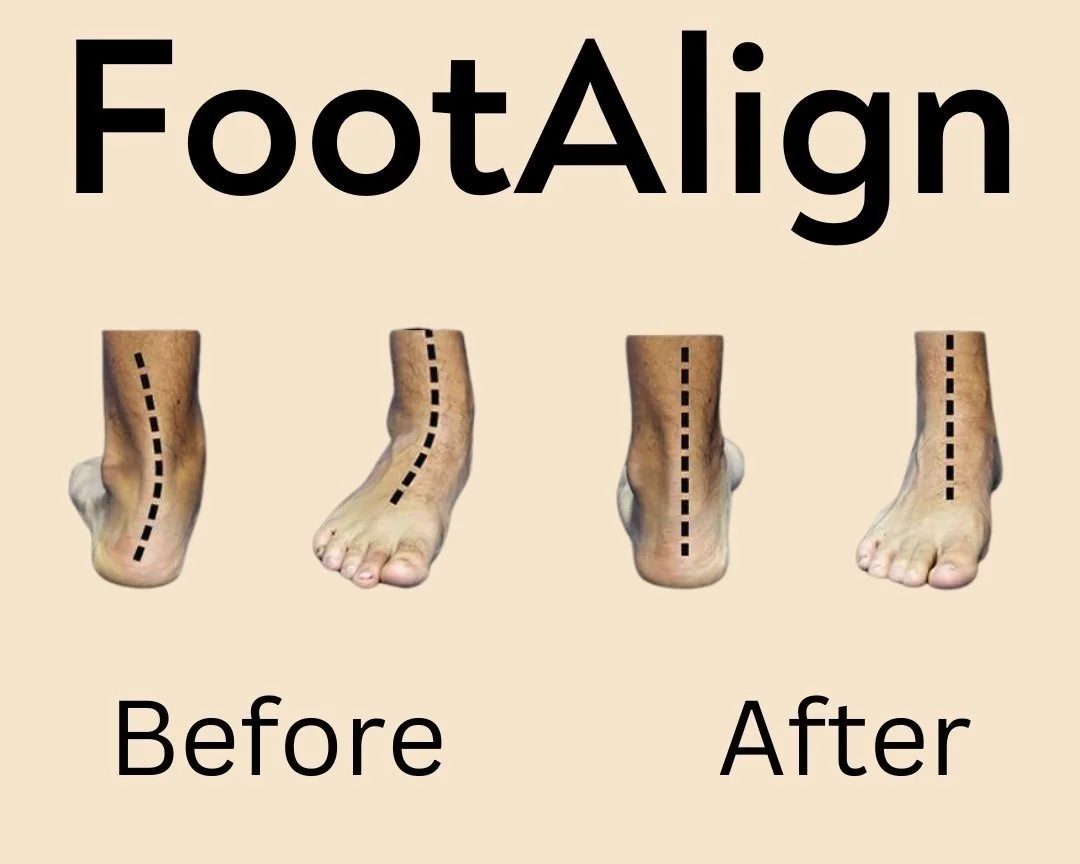 Comparison of feet with misaligned toes before and after foot alignment treatment, showing improved toe alignment in the 'after' images.