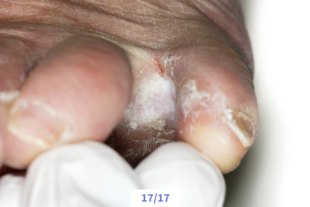 Close-up of a person's fingernails with signs of nail fungus or infection.