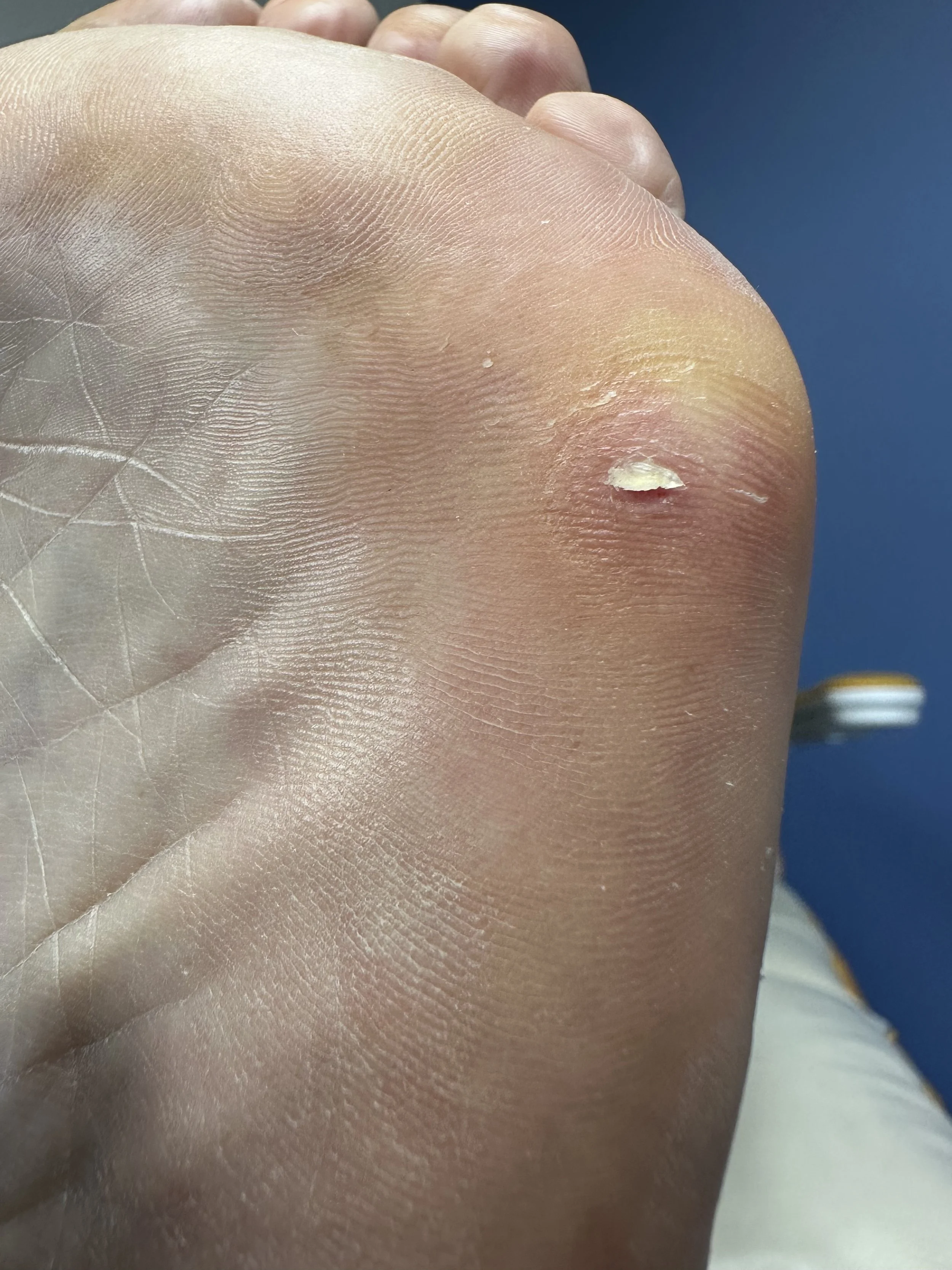 Step 2: Central core of the IPK lesion being clipped