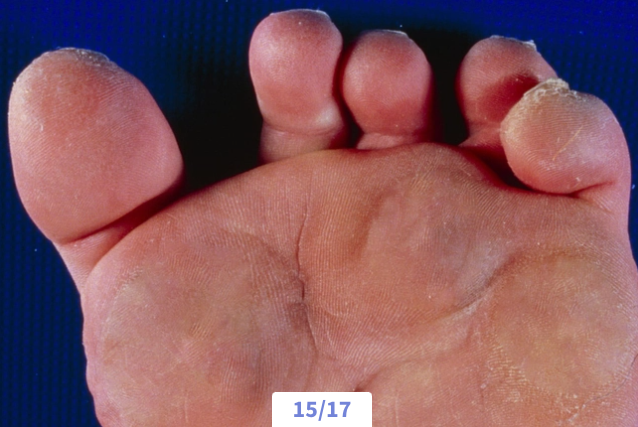 Close-up of the bottom of a person's foot showing dry, cracked skin on the toes and heel.