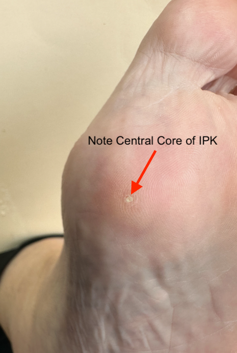 valeri 3 months, central core.png