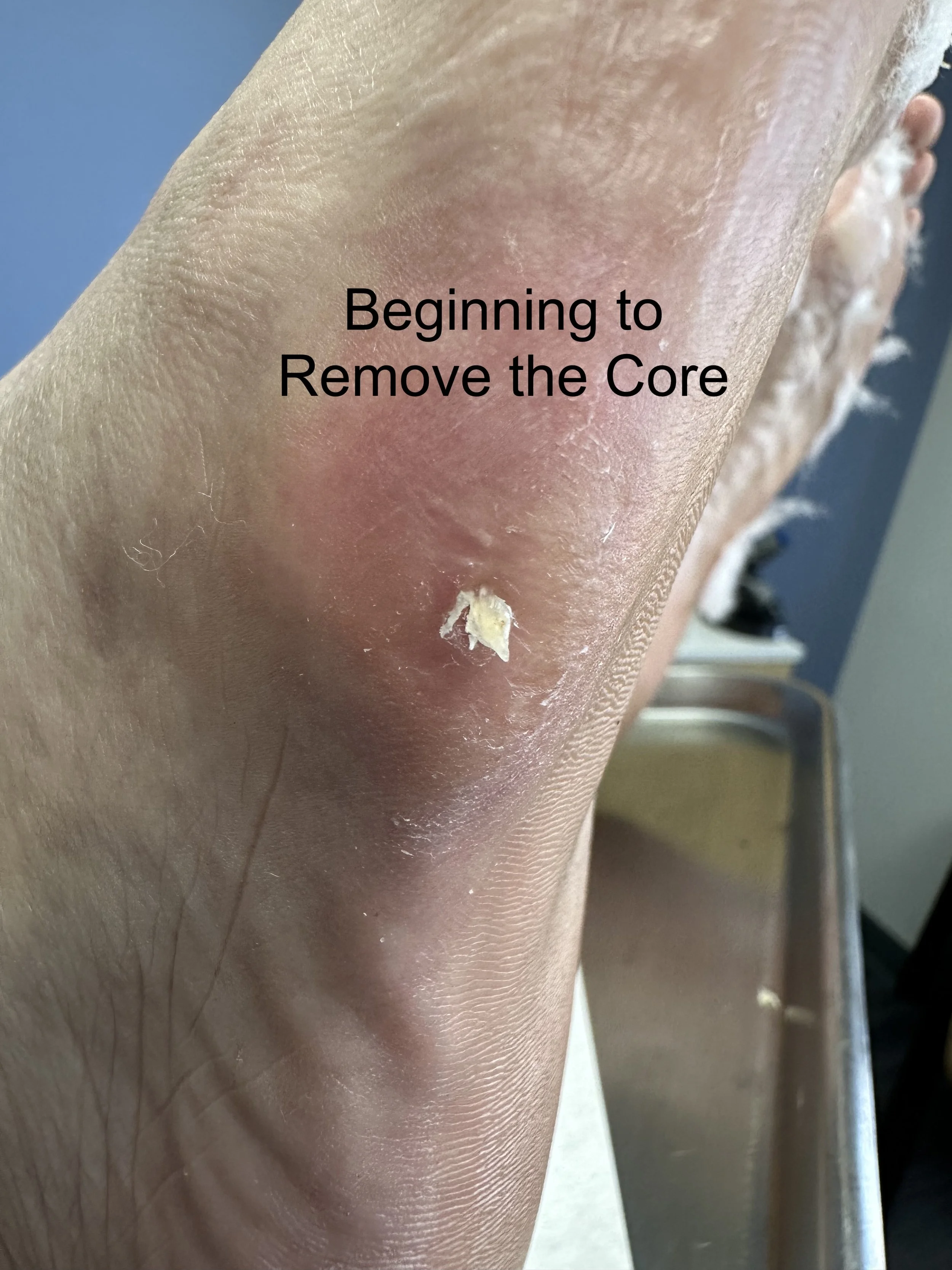 Close-up of a person's skin with a small area of peeling or damaged skin, with the text 'Beginning to Remove the Core' overlayed.